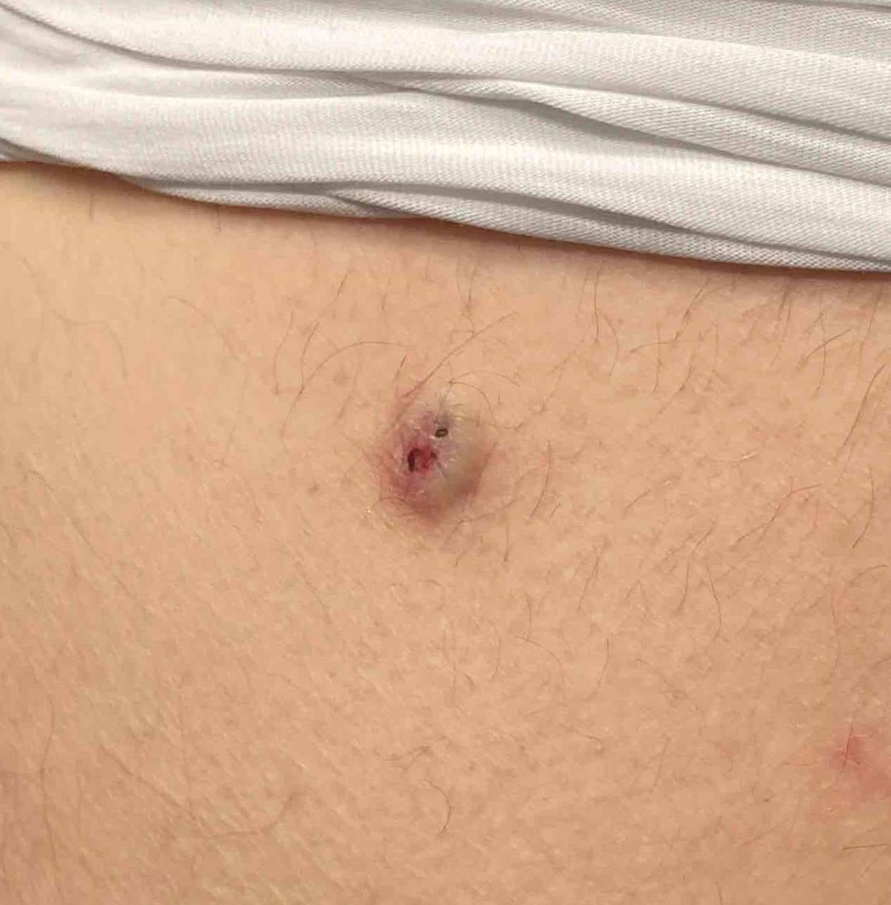 Cyst Removal Before and After Case-12 Before