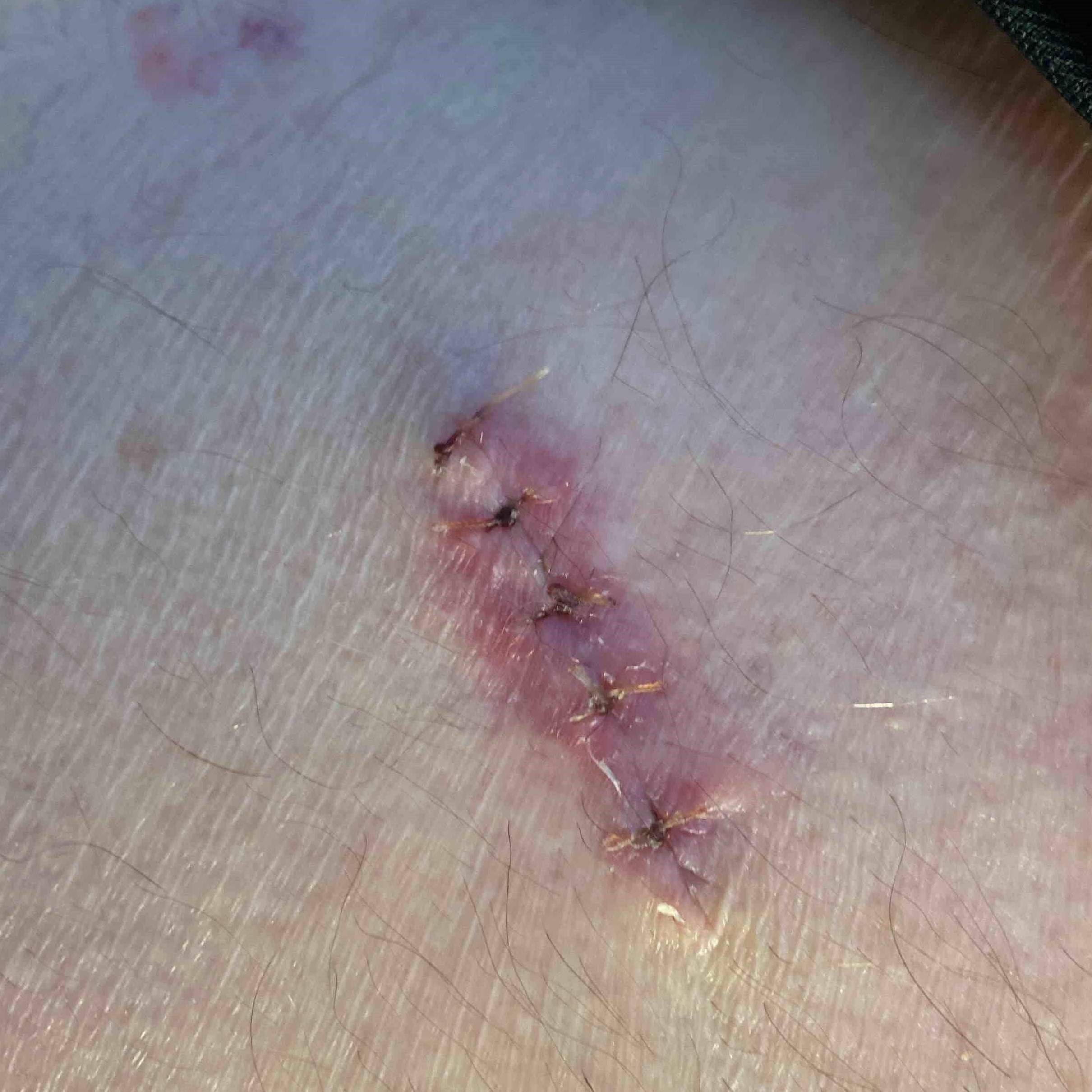 Cyst Removal Before and After Case-12 After