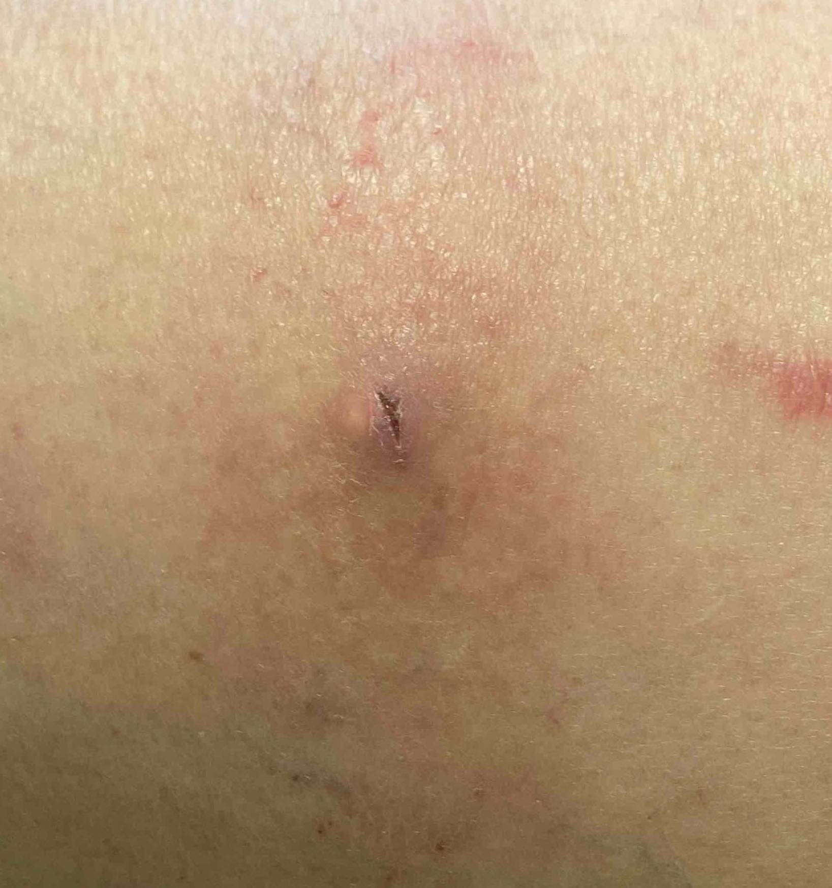 Cyst Removal Before and After Case-13 Before