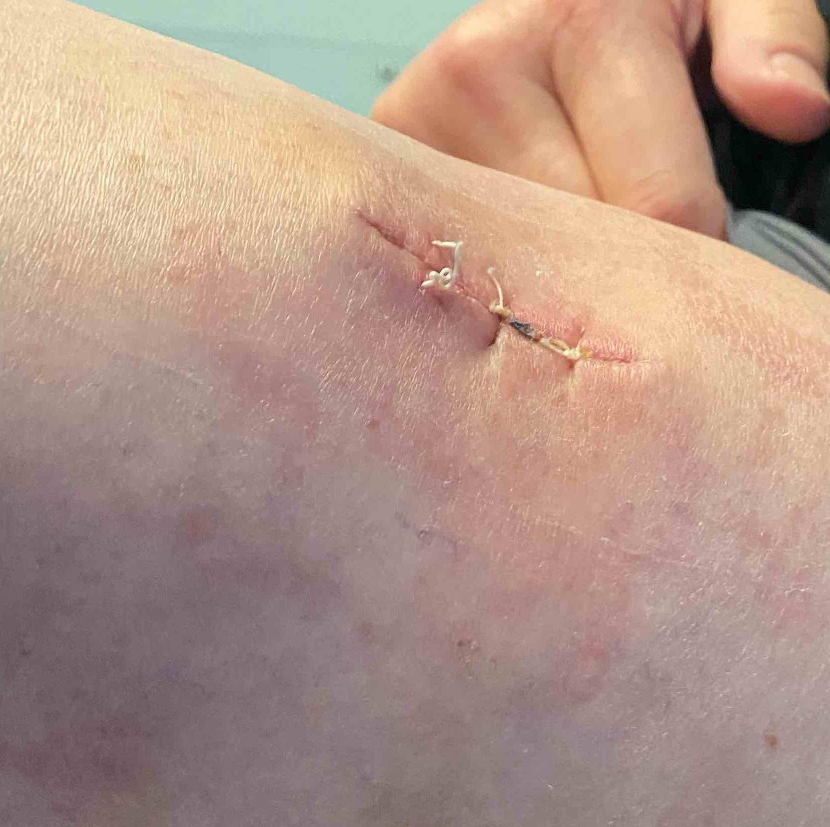 Cyst Removal Before and After Case-13 After