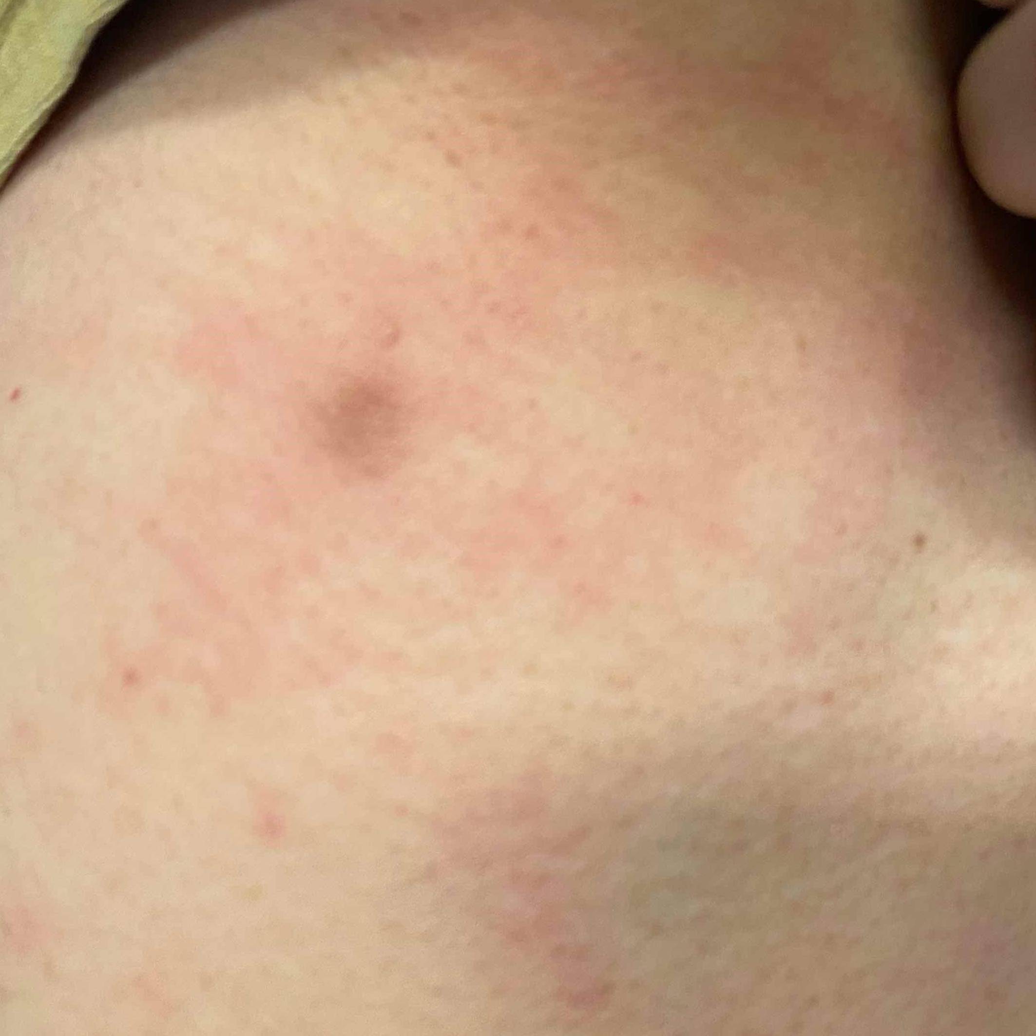 Cyst Removal Before and After Case-14 Before