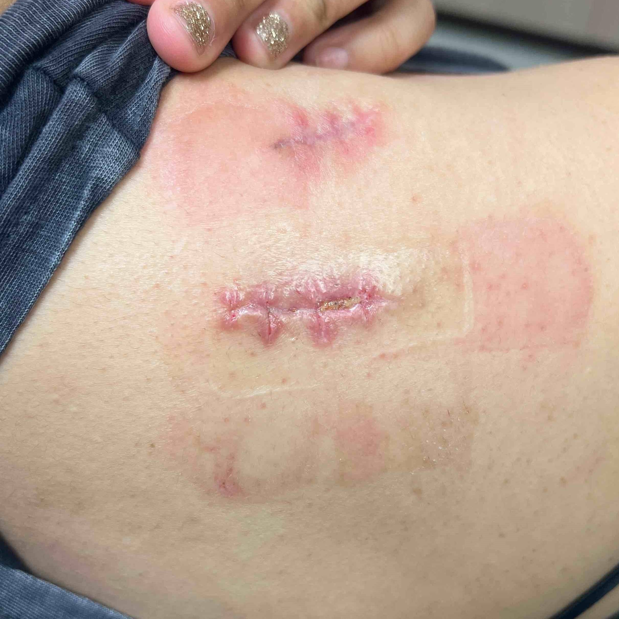 Cyst Removal Before and After Case-14 After