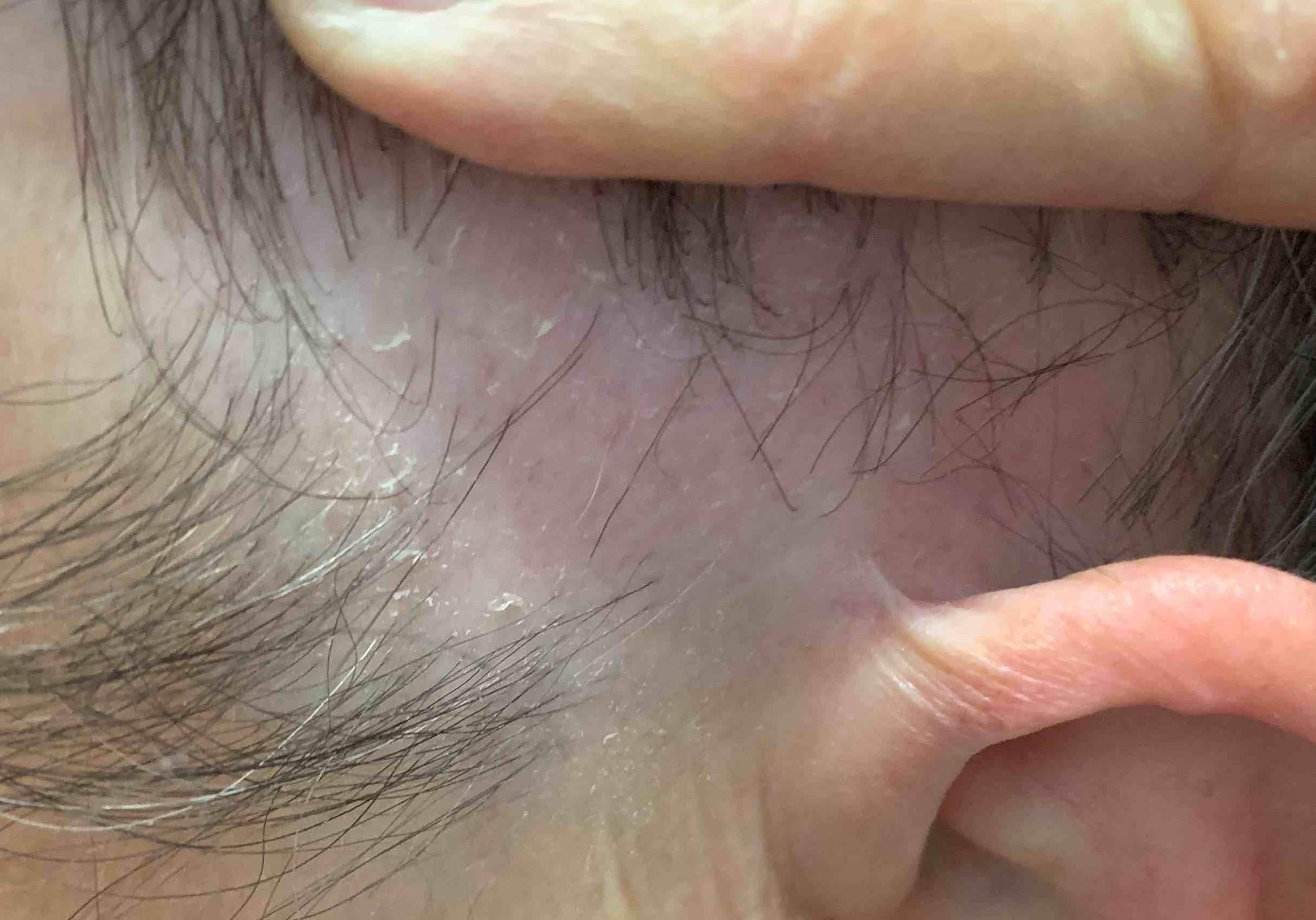 Hair Loss Case-11 Before