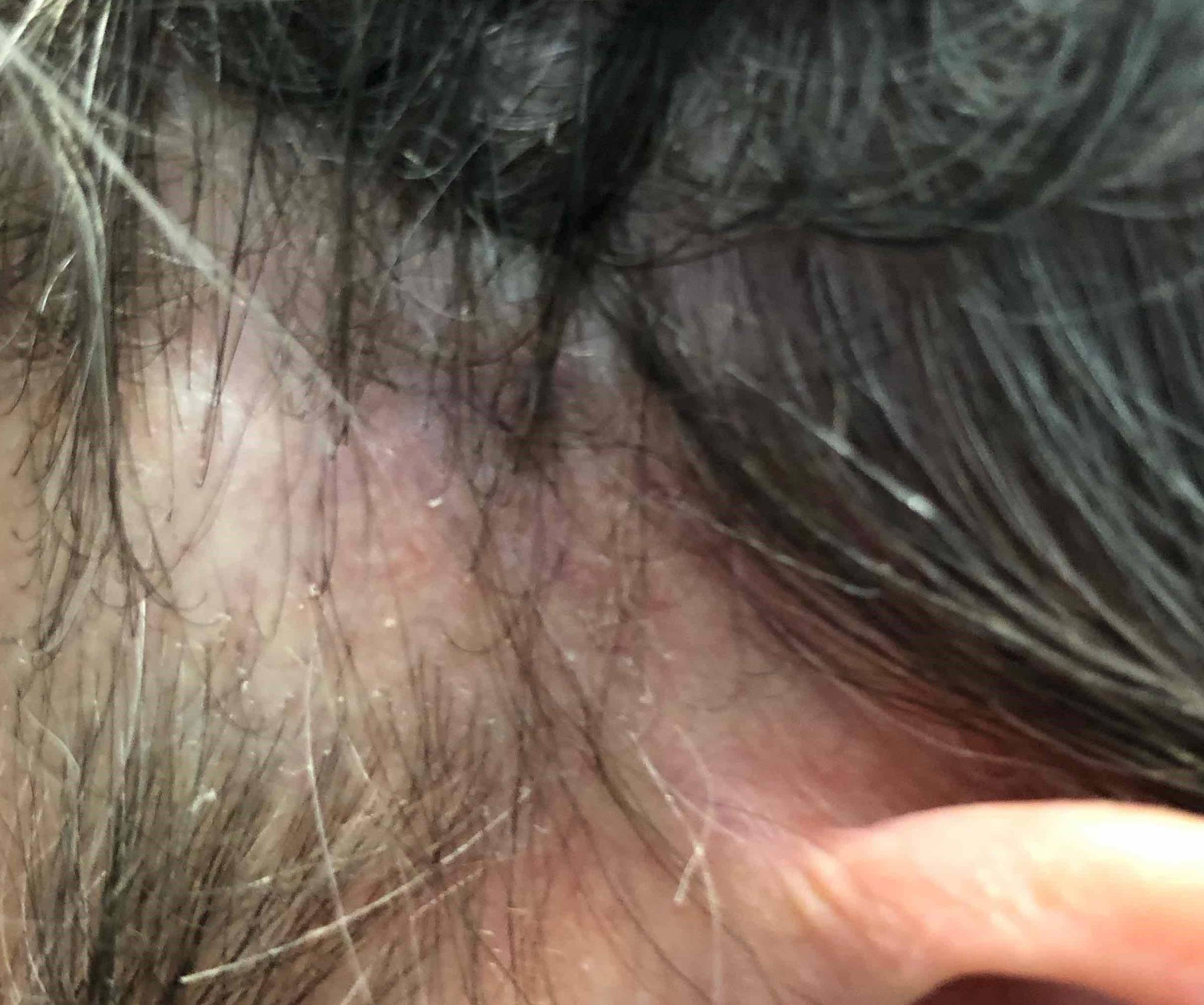 Hair Loss Case-11 After