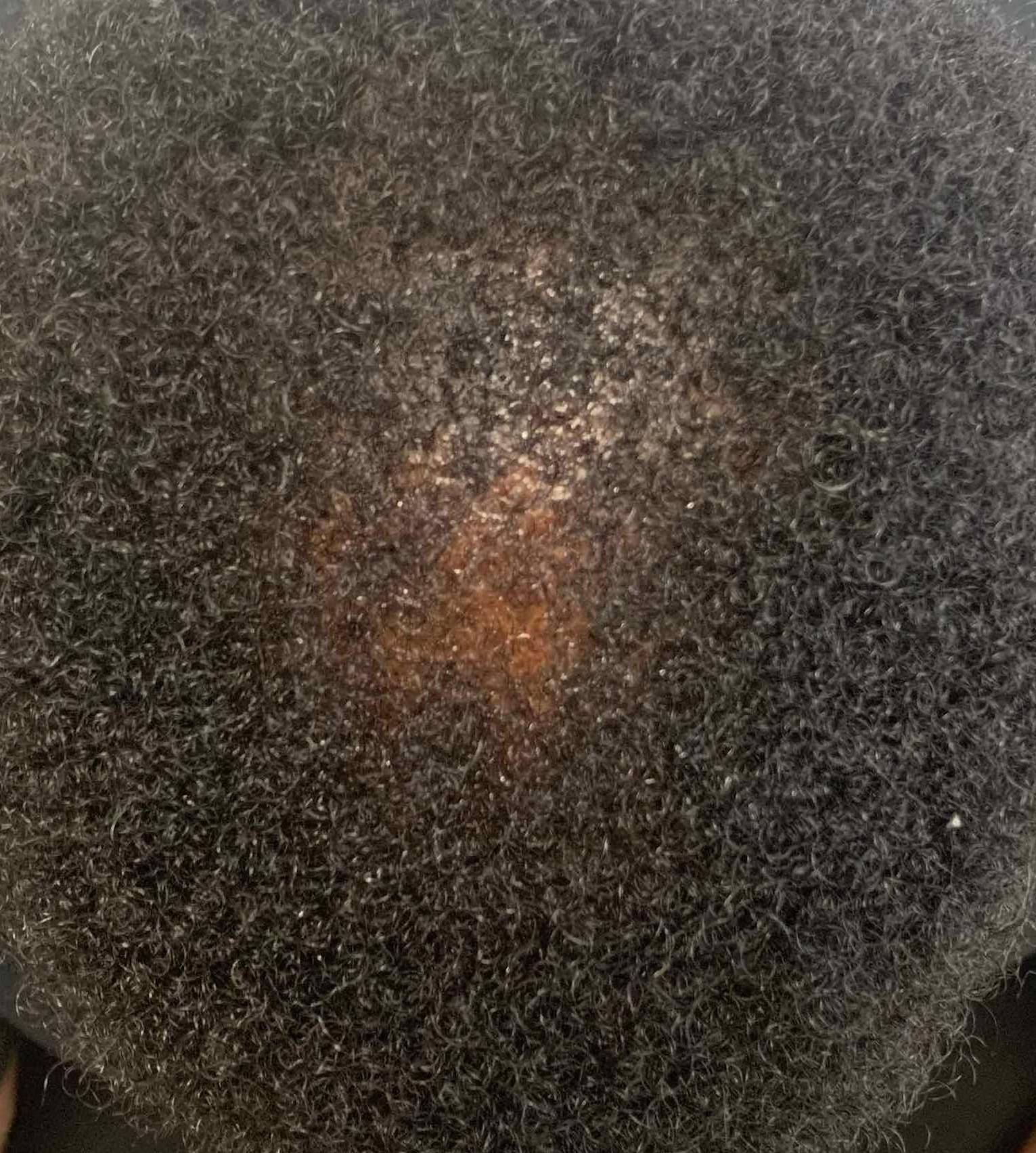 Hair Loss Case-12 After