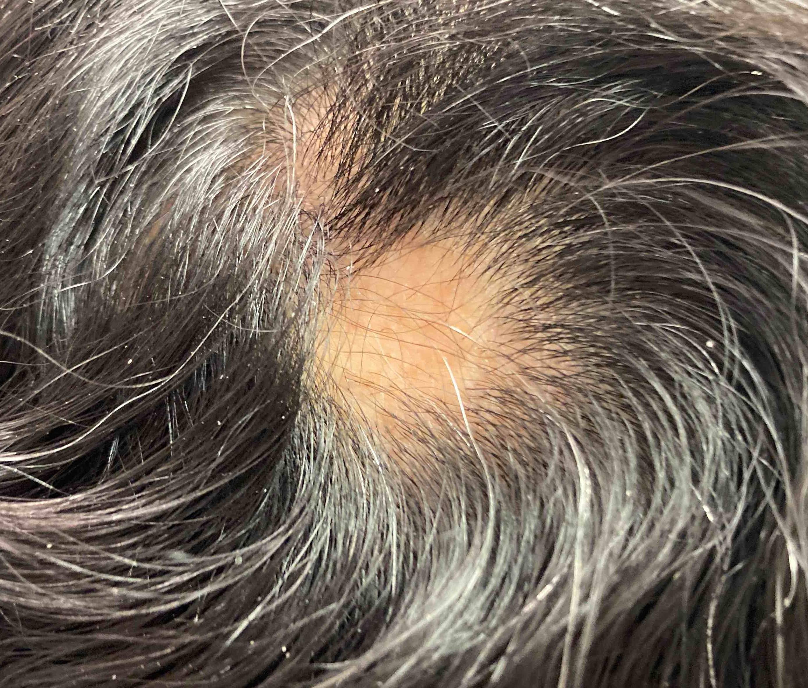 Hair Loss Case-13 Before