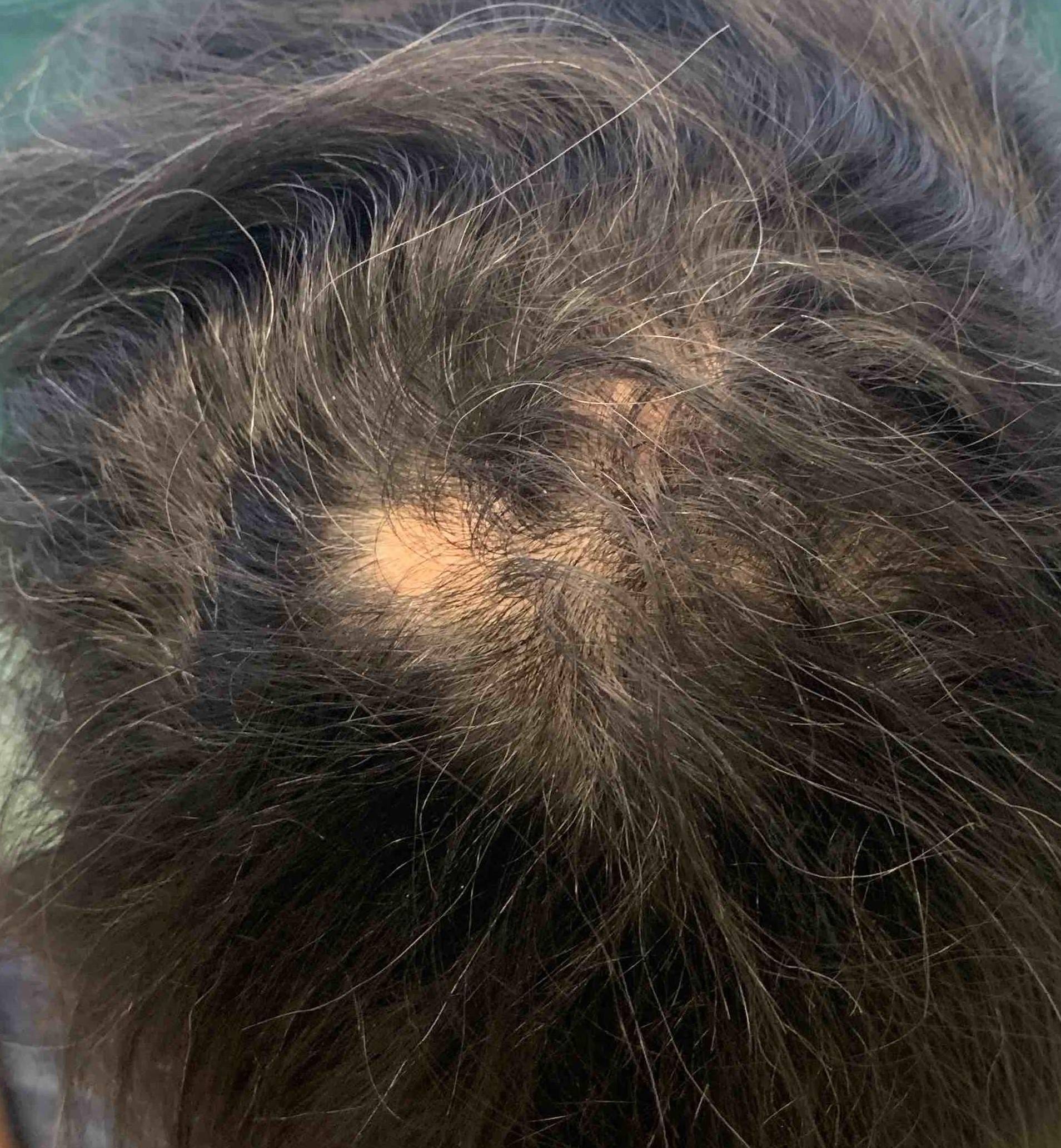 Hair Loss Case-13 After