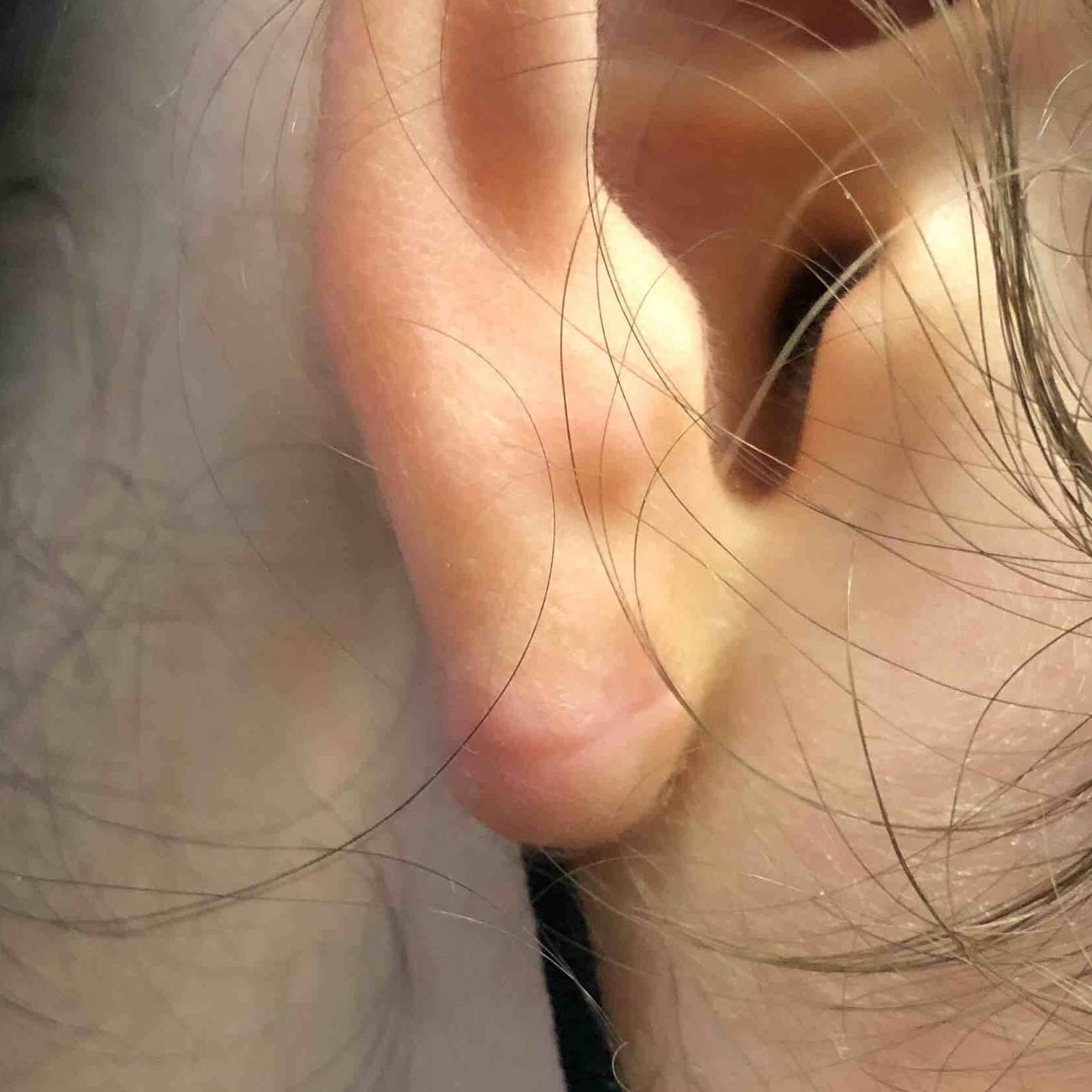 Keloids Before and After After