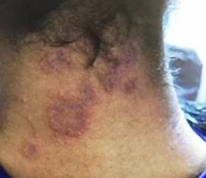 Psoriasis Before and After Case 6 Before