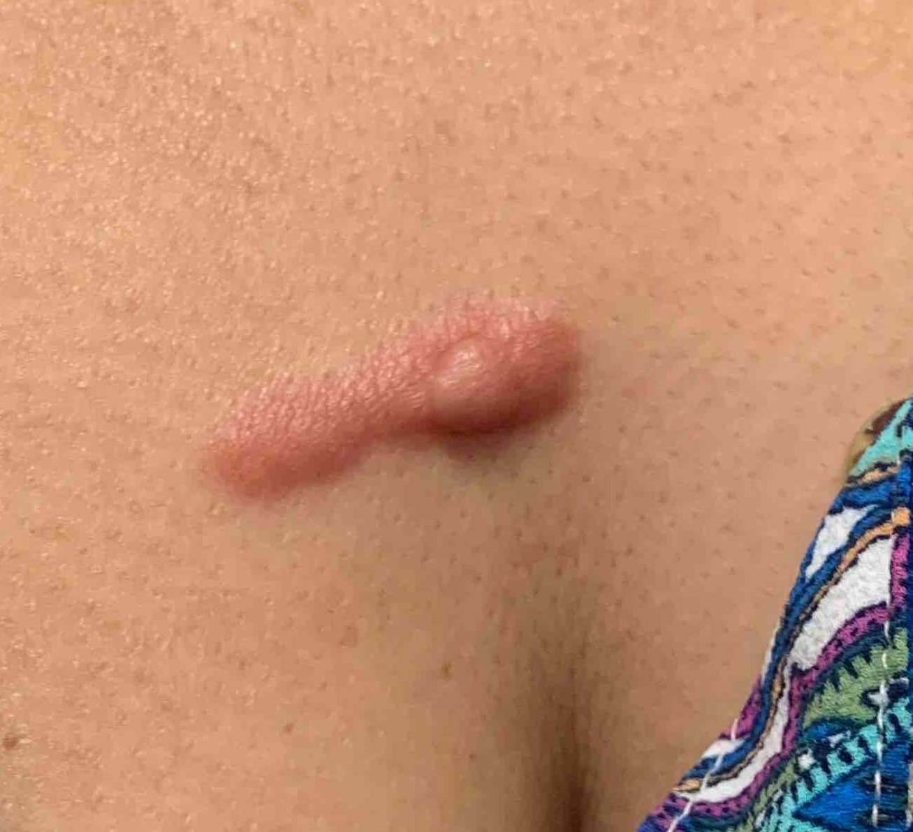 Keloids Before and After Case-16 Before