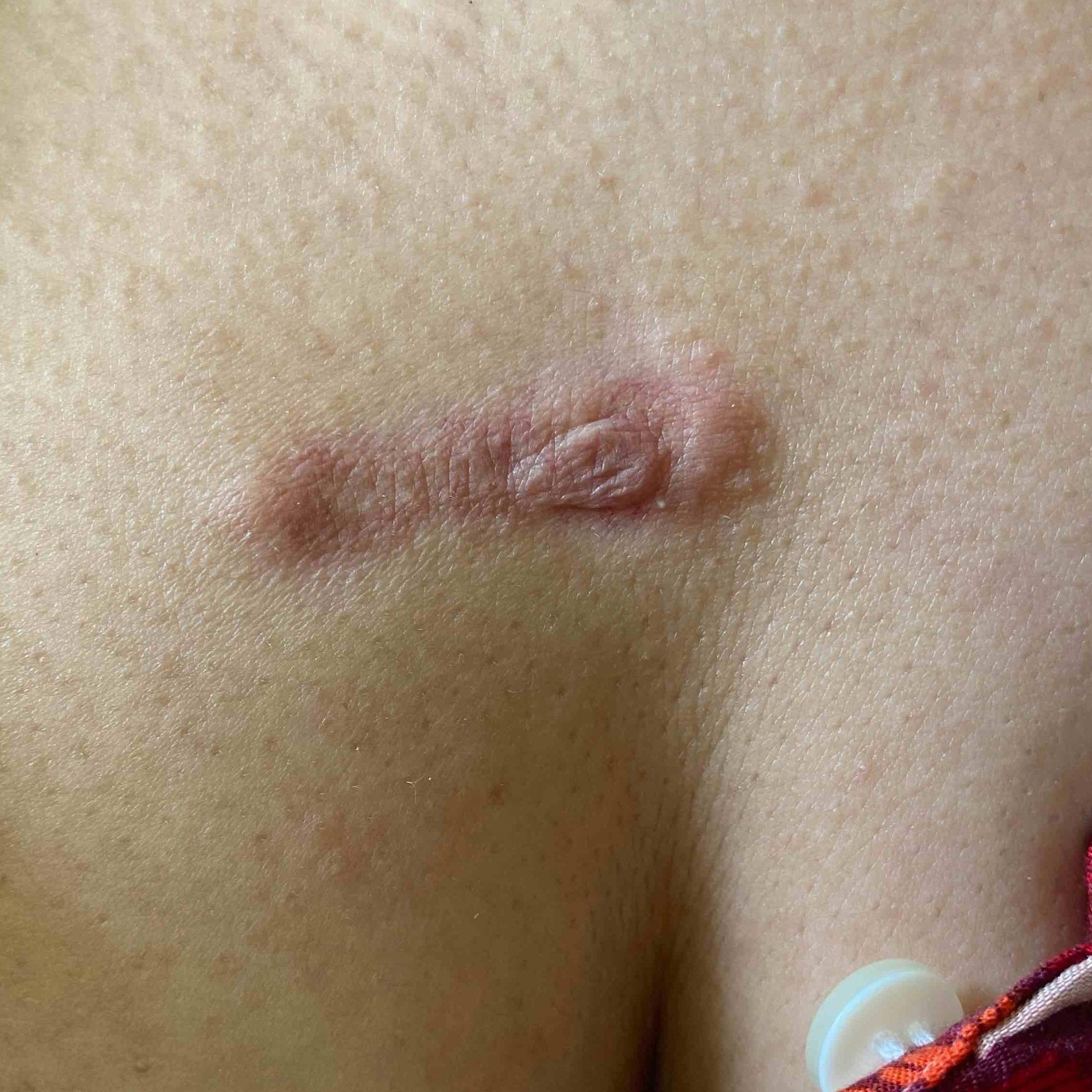 Keloids Before and After Case-16 After