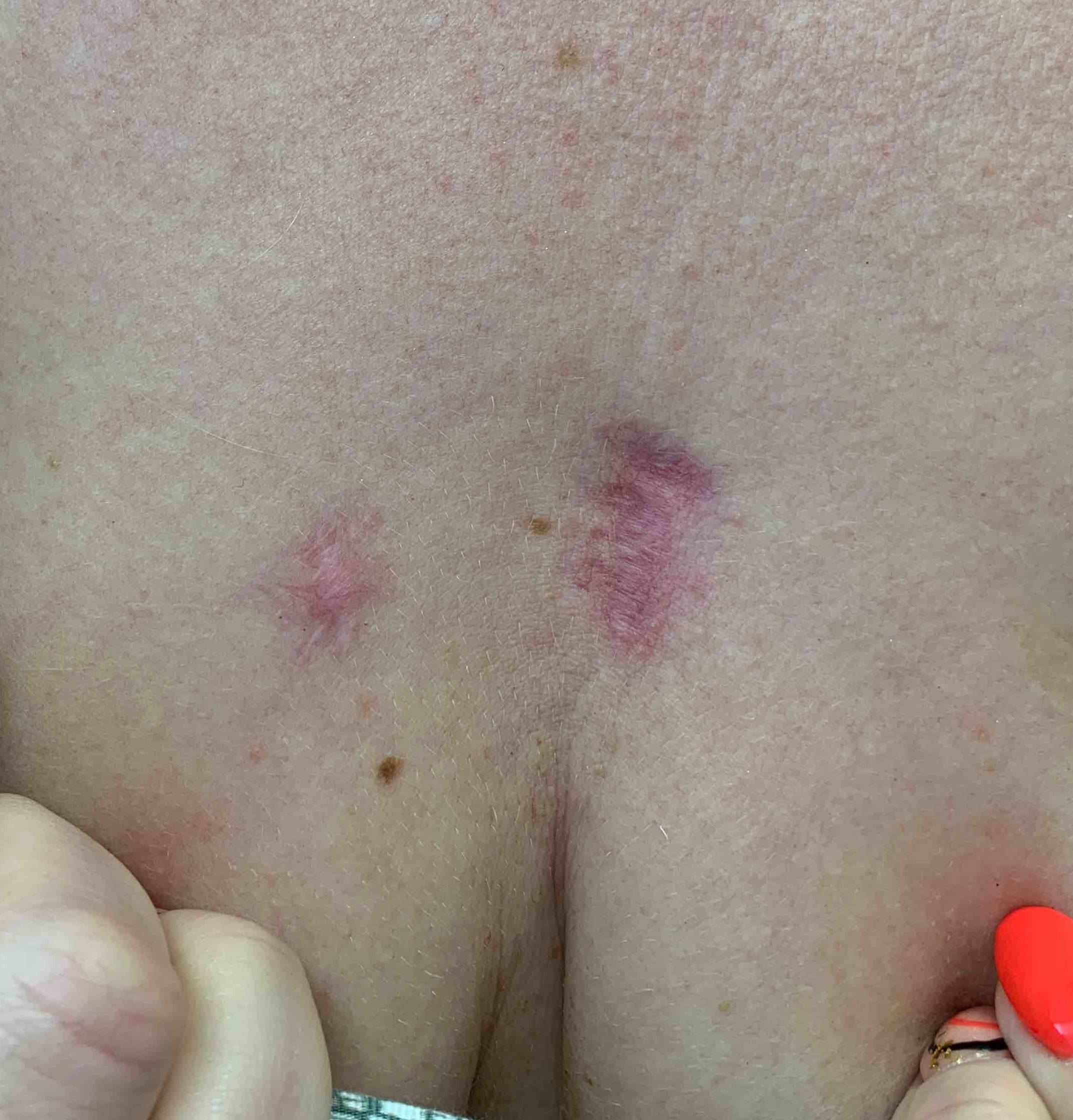 Keloids Before and After Case-17 Before