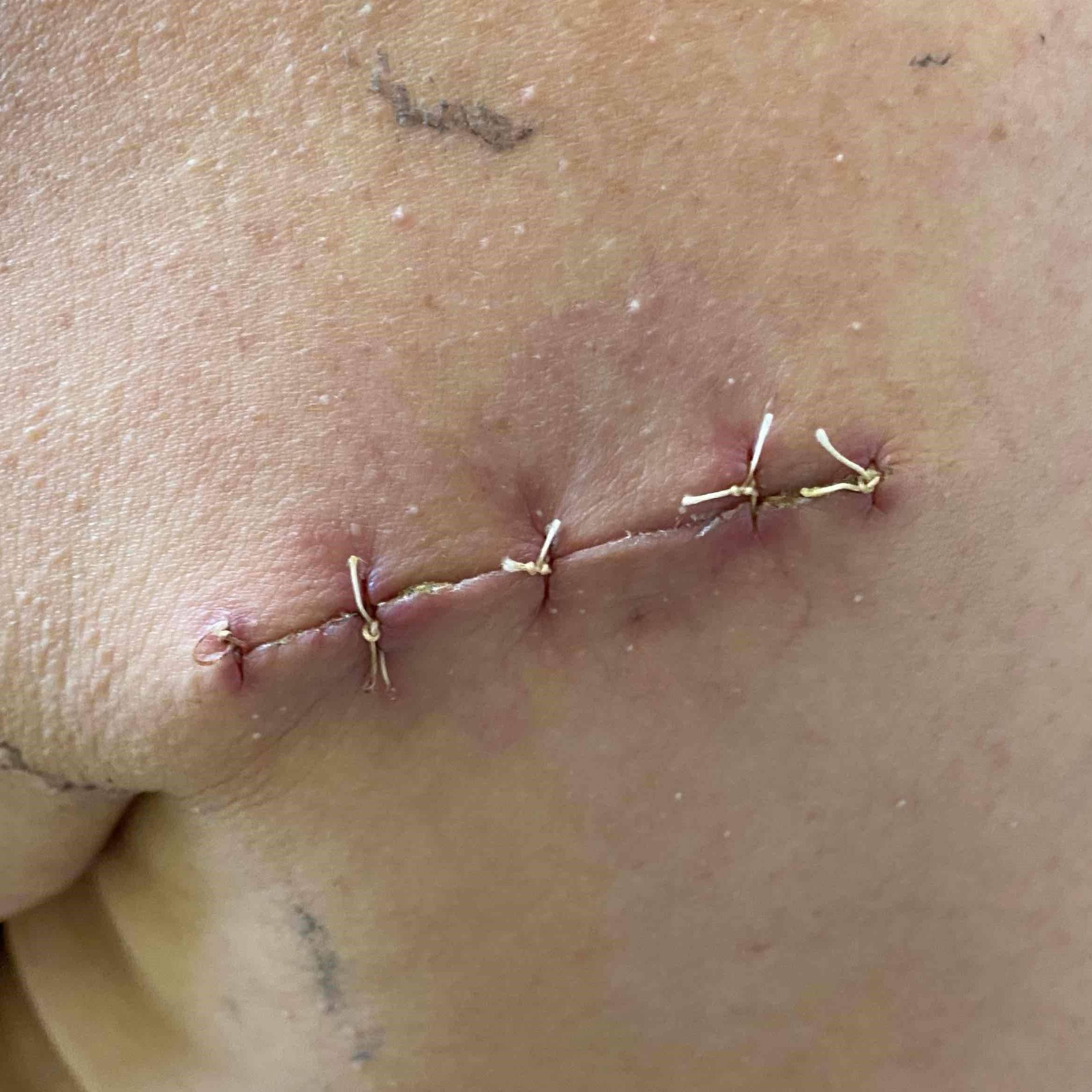 Lipoma Before and After Case-5 After