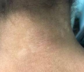 Psoriasis Before and After Case 6 After