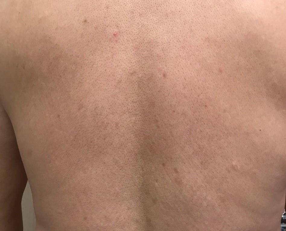 Psoriasis (3 Month Cosentyx) Case-39 After