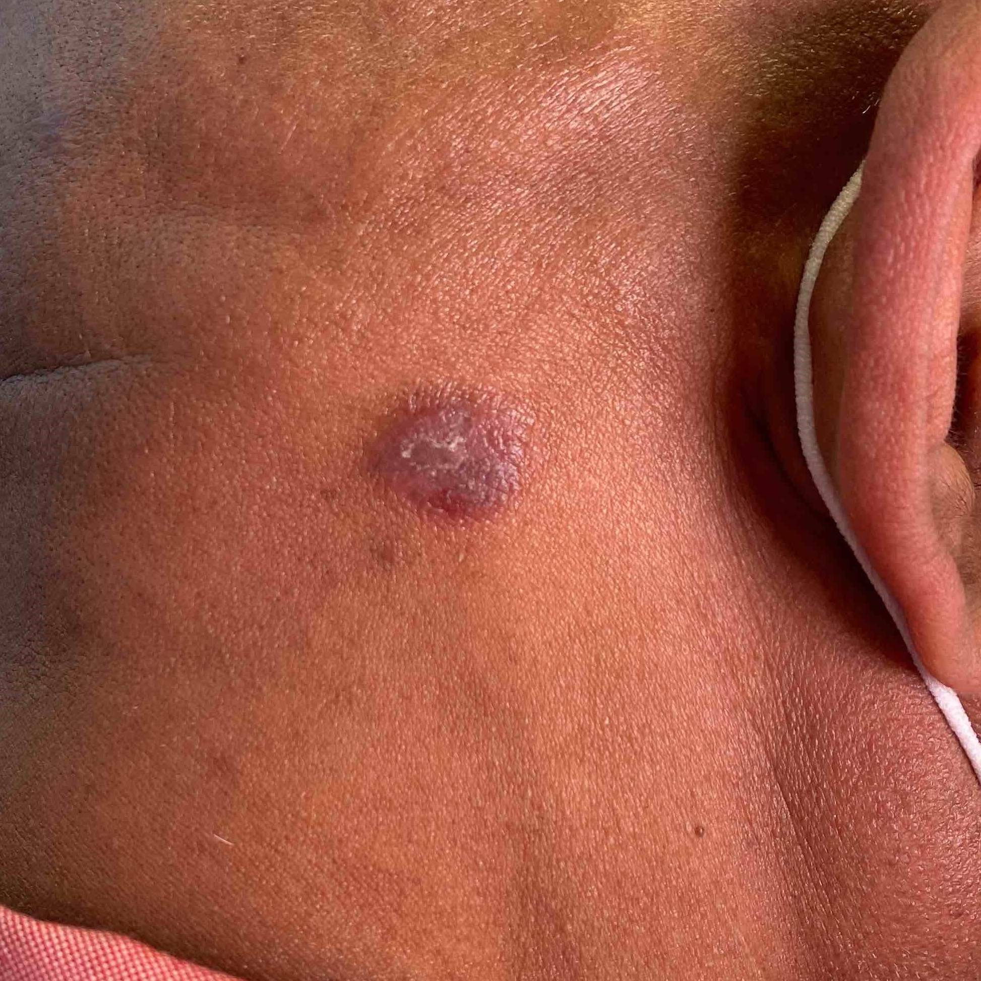 Psoriasis (1 Month Cocentyx) Case-40 Before