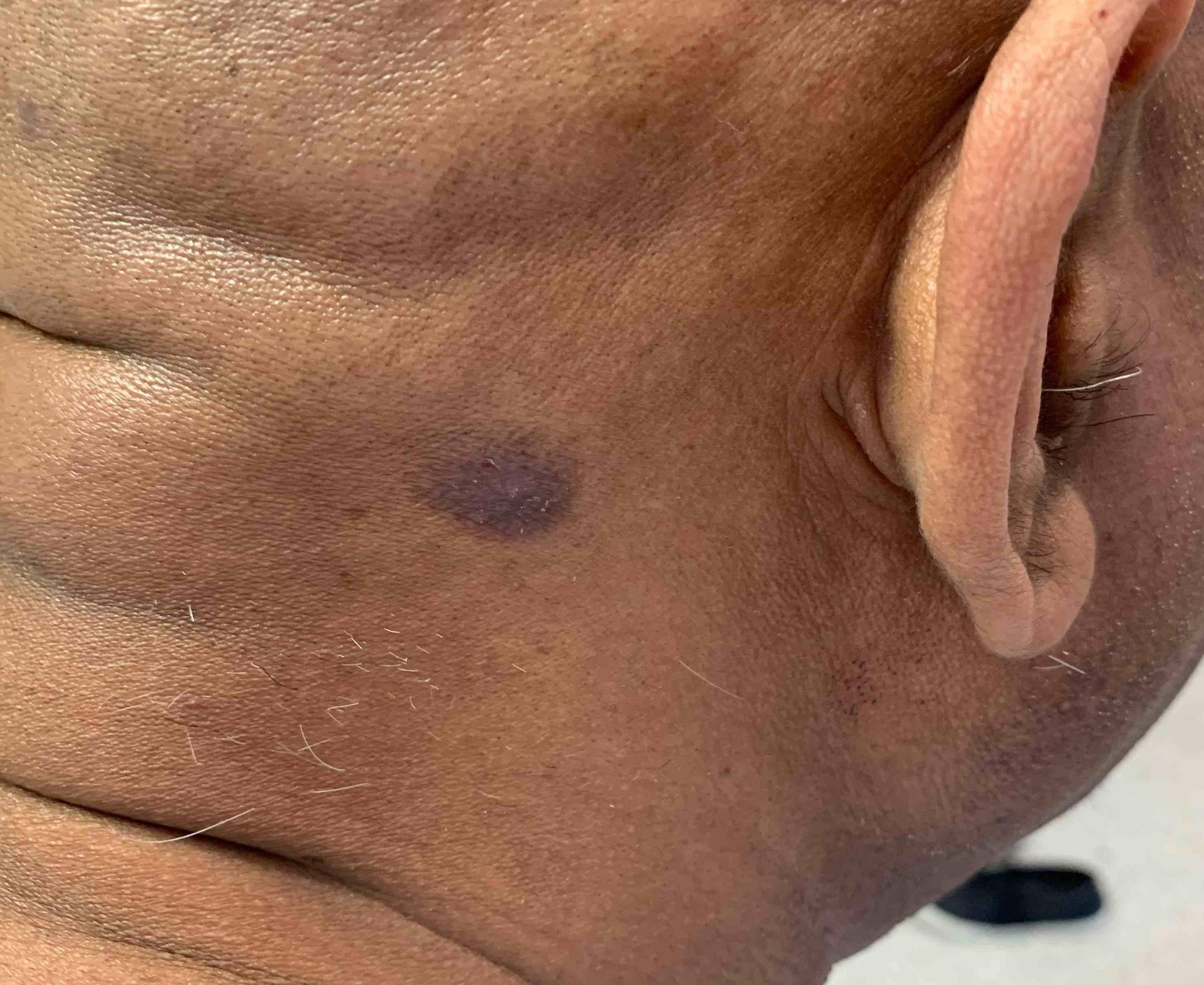 Psoriasis (1 Month Cocentyx) Case-40 After