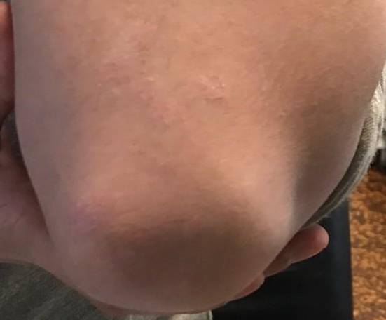 Psoriasis (6 Month Taltz) Case-41 After