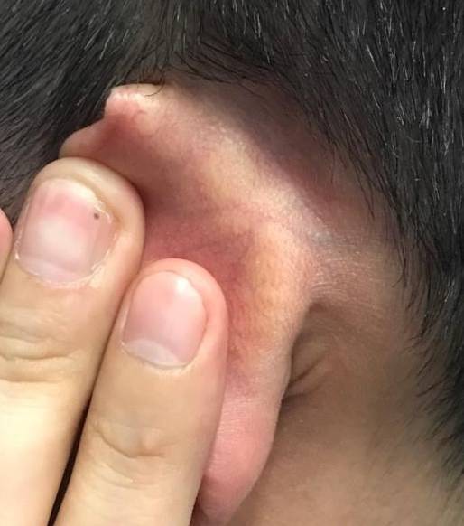 Psoriasis (6 Month Taltz) Case-42 After