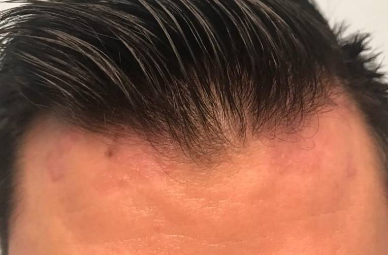 Psoriasis (6 Month Taltz) Case-43 Before