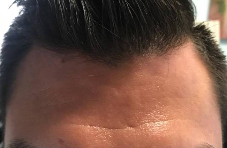 Psoriasis (6 Month Taltz) Case-43 After