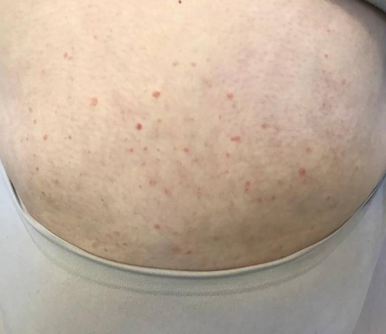 Psoriasis (6 Month Cosentyx) Case-44 Before
