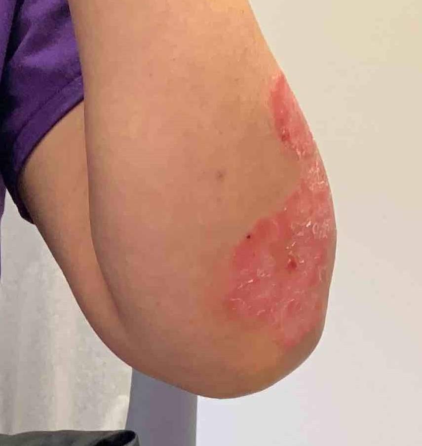 Psoriasis (6 Month Cosentyx) Case-11 Before