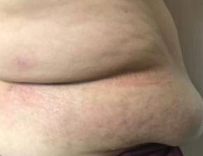 Psoriasis Before and After Case 7 After