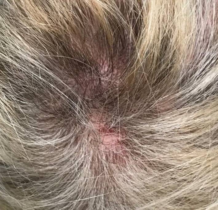 Psoriasis (6 Month Cosentyx) Case-16 Before
