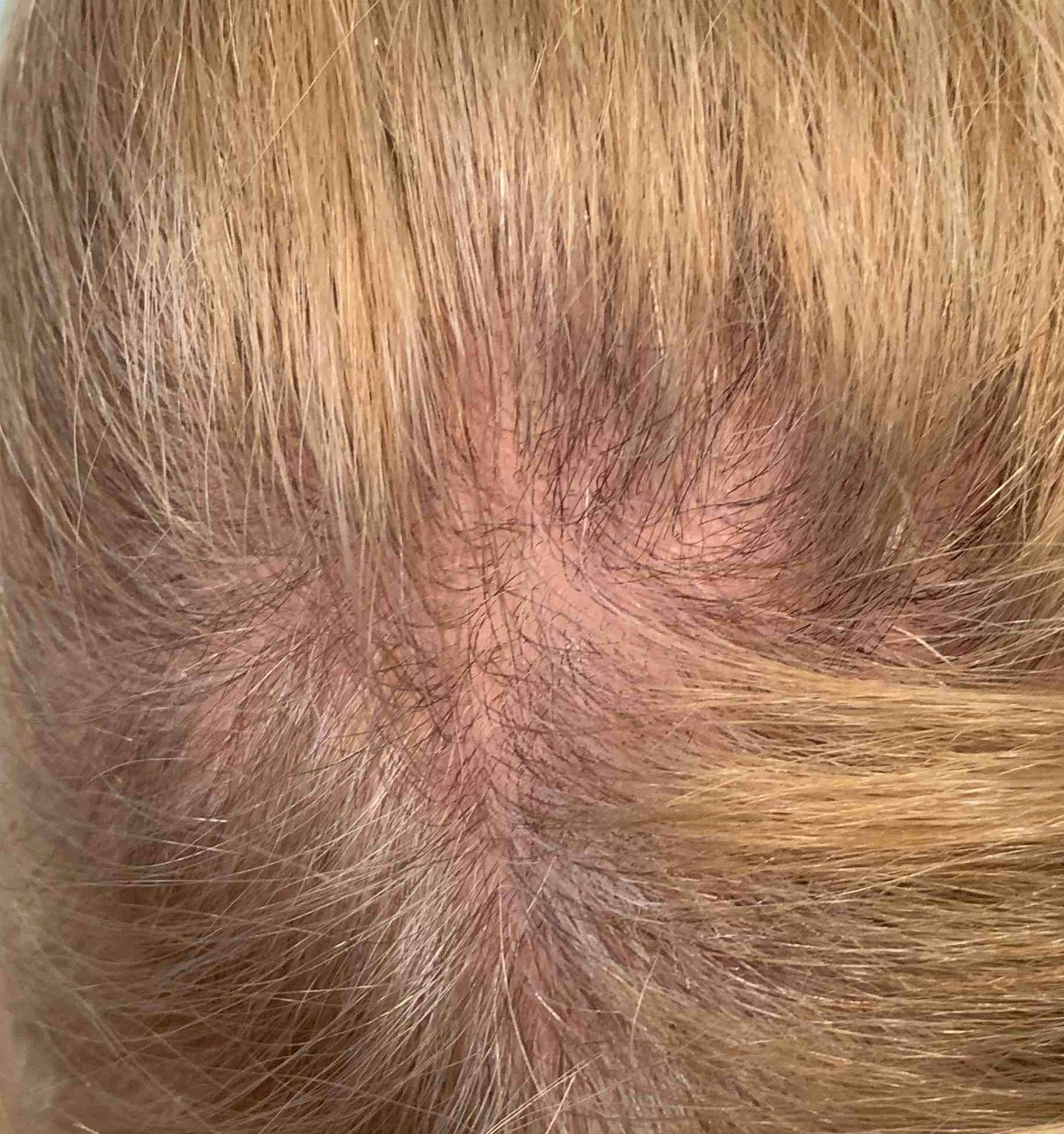Psoriasis (6 Month Cosentyx) Case-16 After