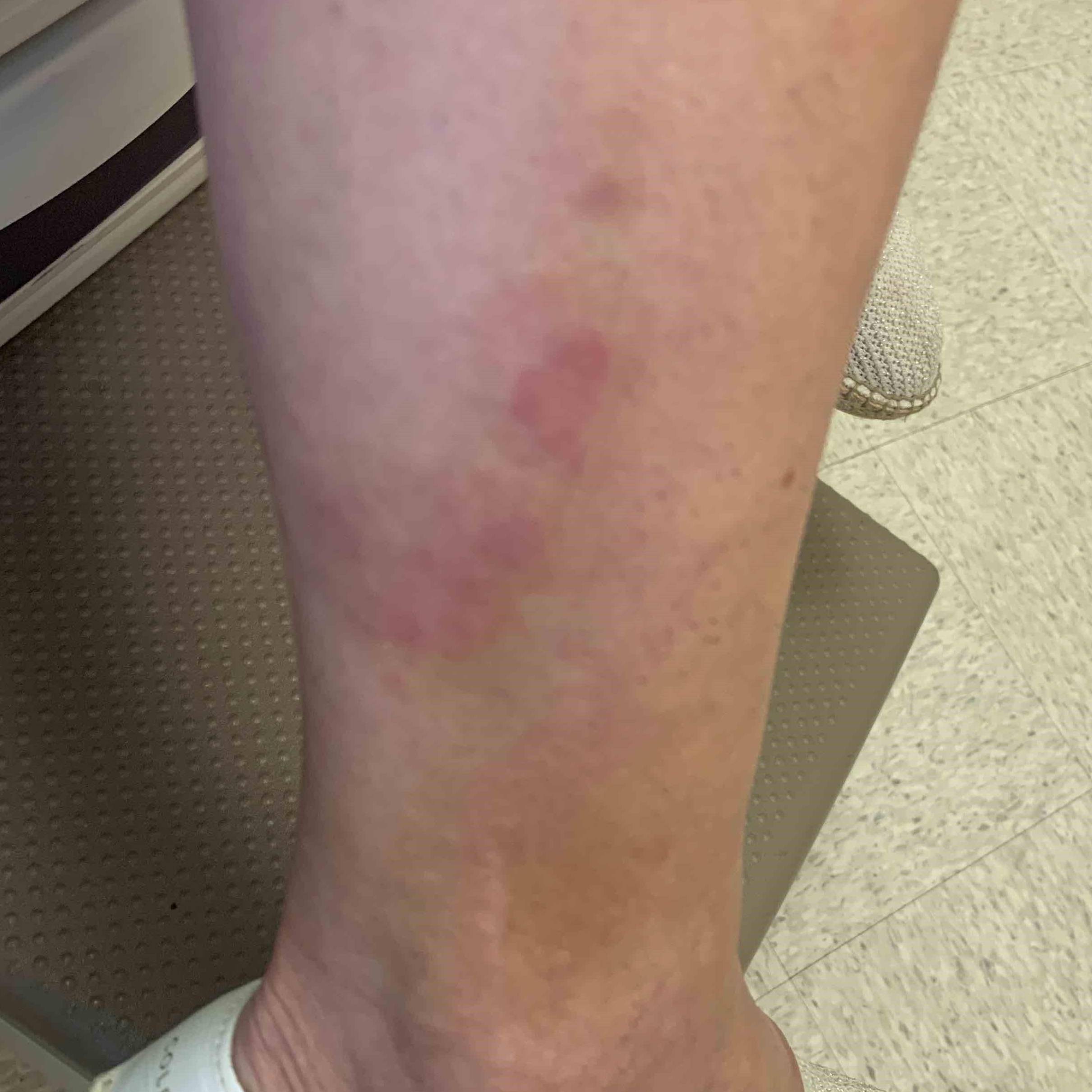 Psoriasis (6 Month Taltz) Case-46 Before