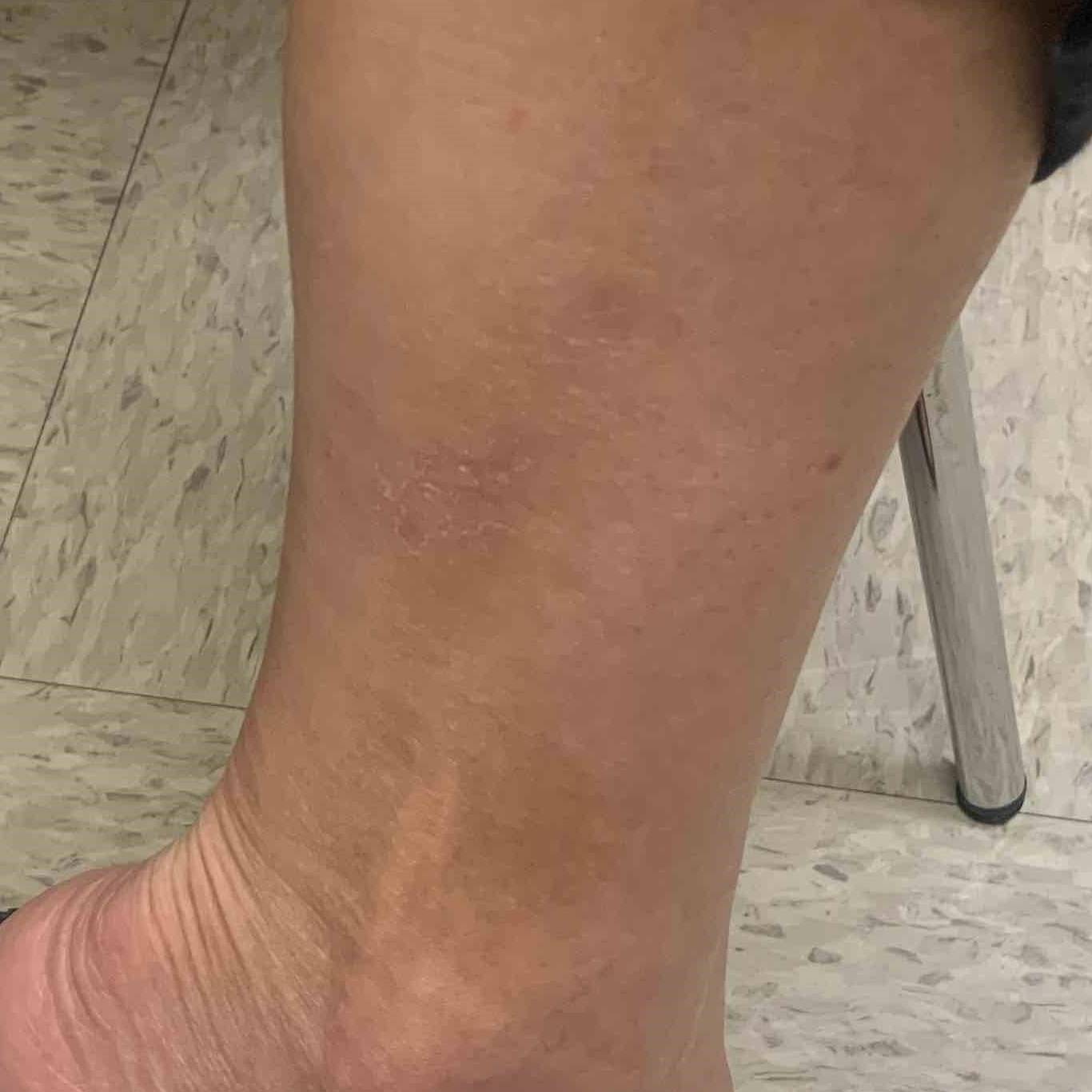 Psoriasis (6 Month Taltz) Case-46 After