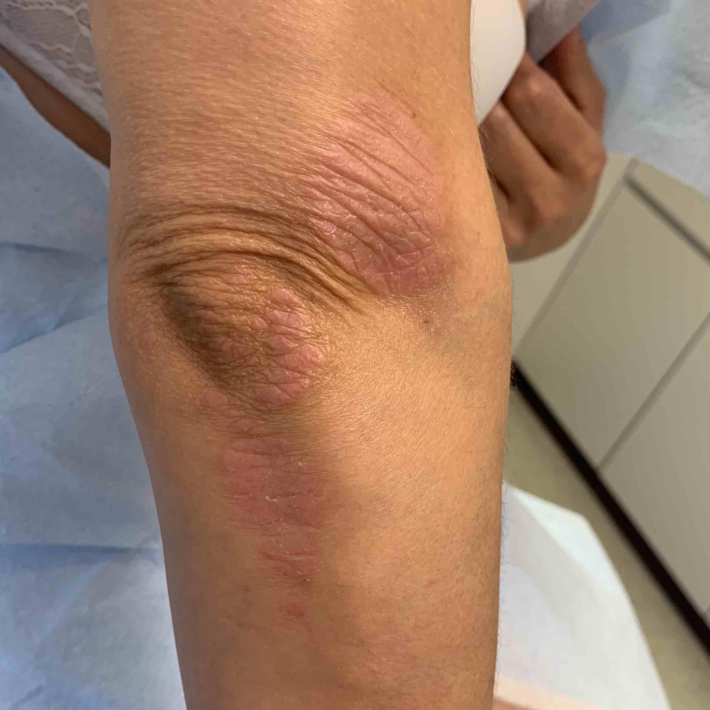 Psoriasis (6 Month Taltz) Case-47 Before