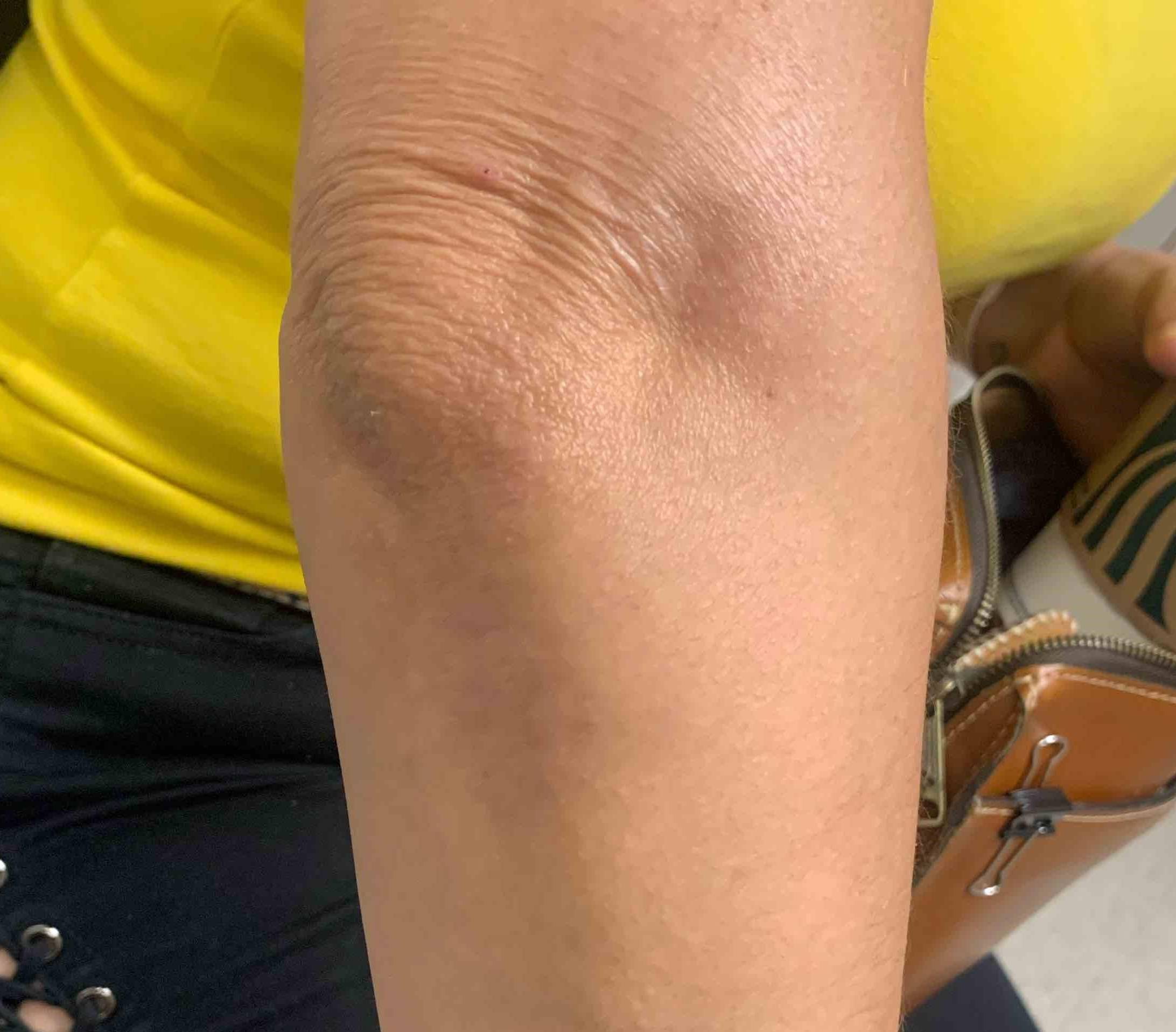 Psoriasis (6 Month Taltz) Case-47 After