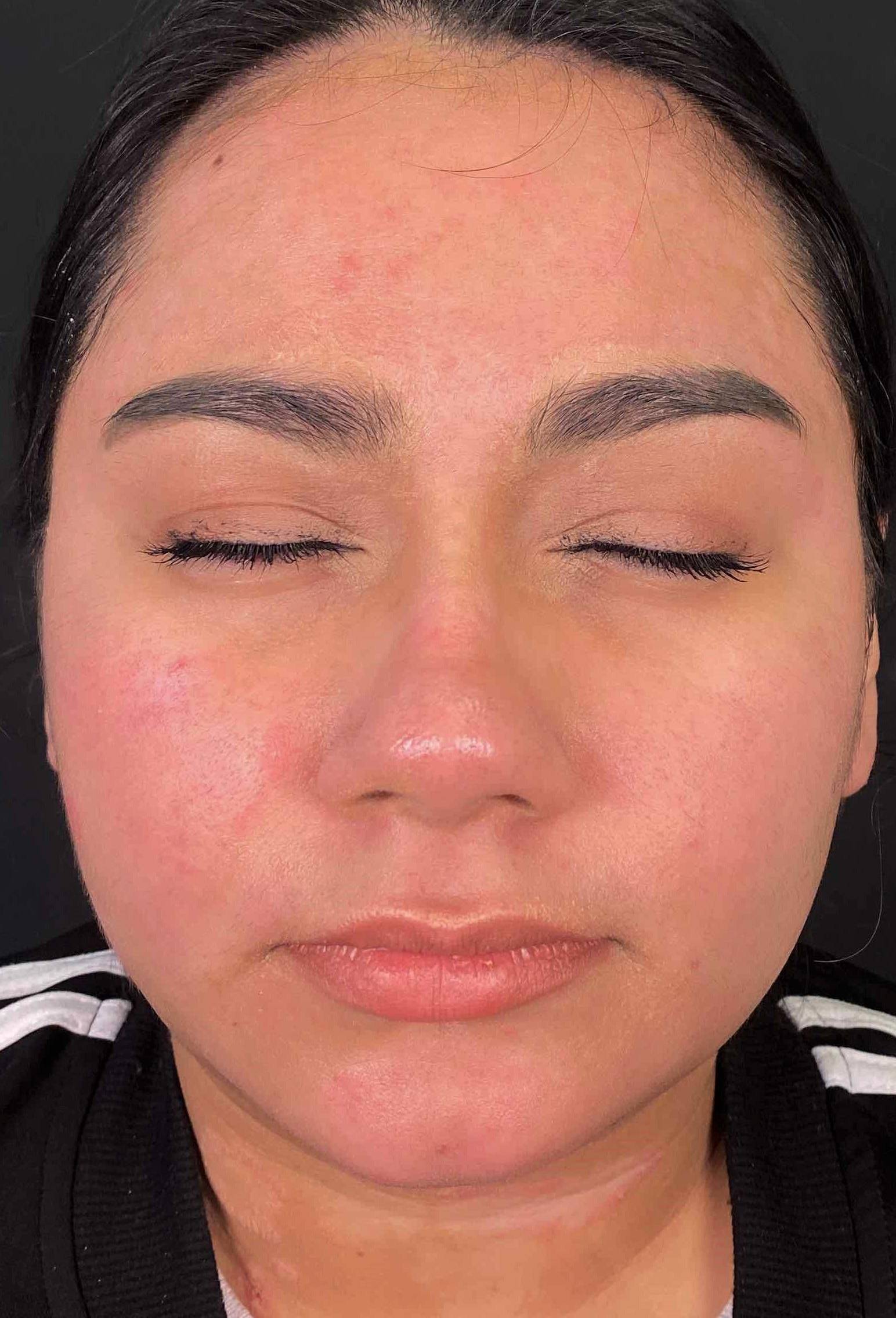 Psoriasis (6 Month Cimzia) Case-48 Before