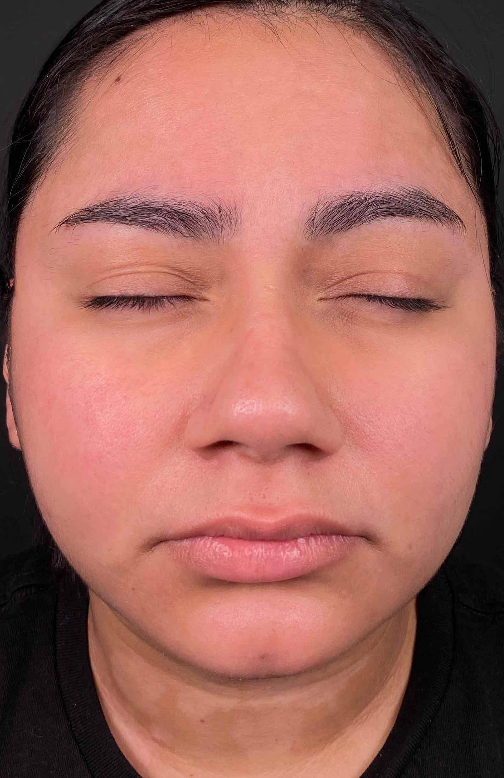 Psoriasis (6 Month Cimzia) Case-48 After