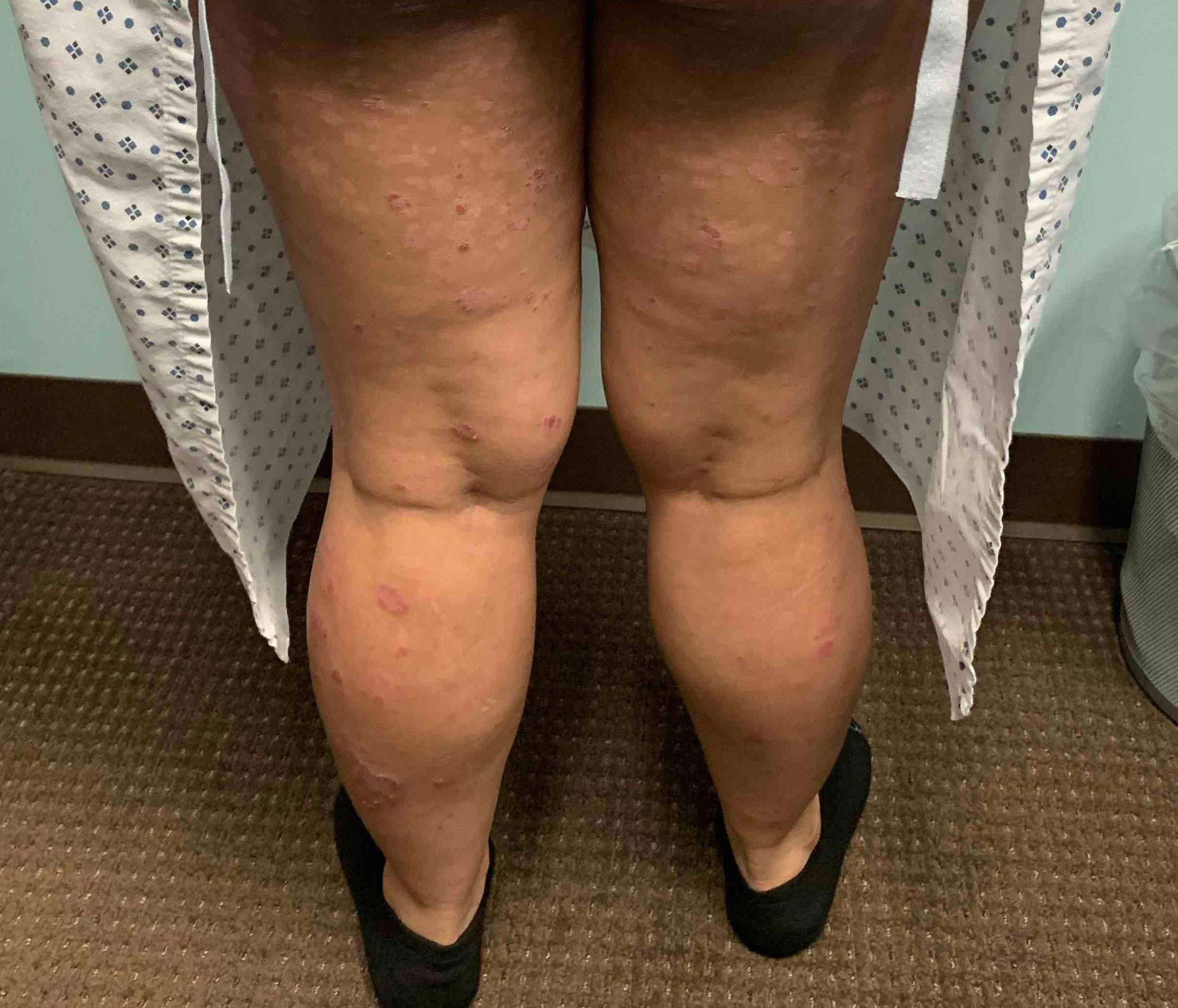 Psoriasis (6 Month Cimzia) Case-49 After
