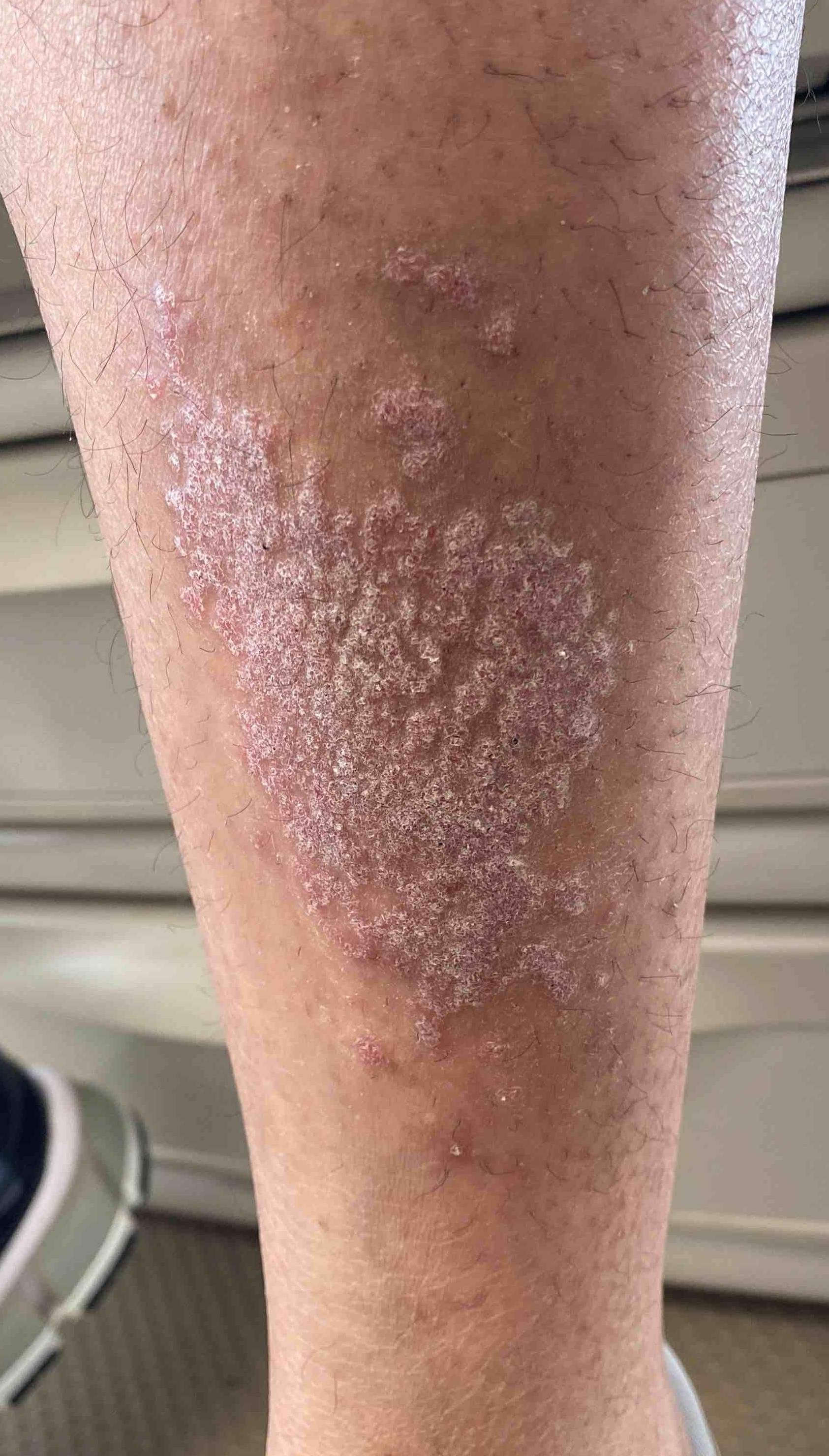 Psoriasis (6 Month Stelera) Case-50 Before