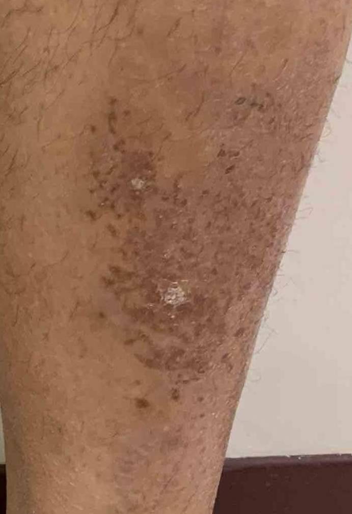 Psoriasis (6 Month Stelera) Case-50 After