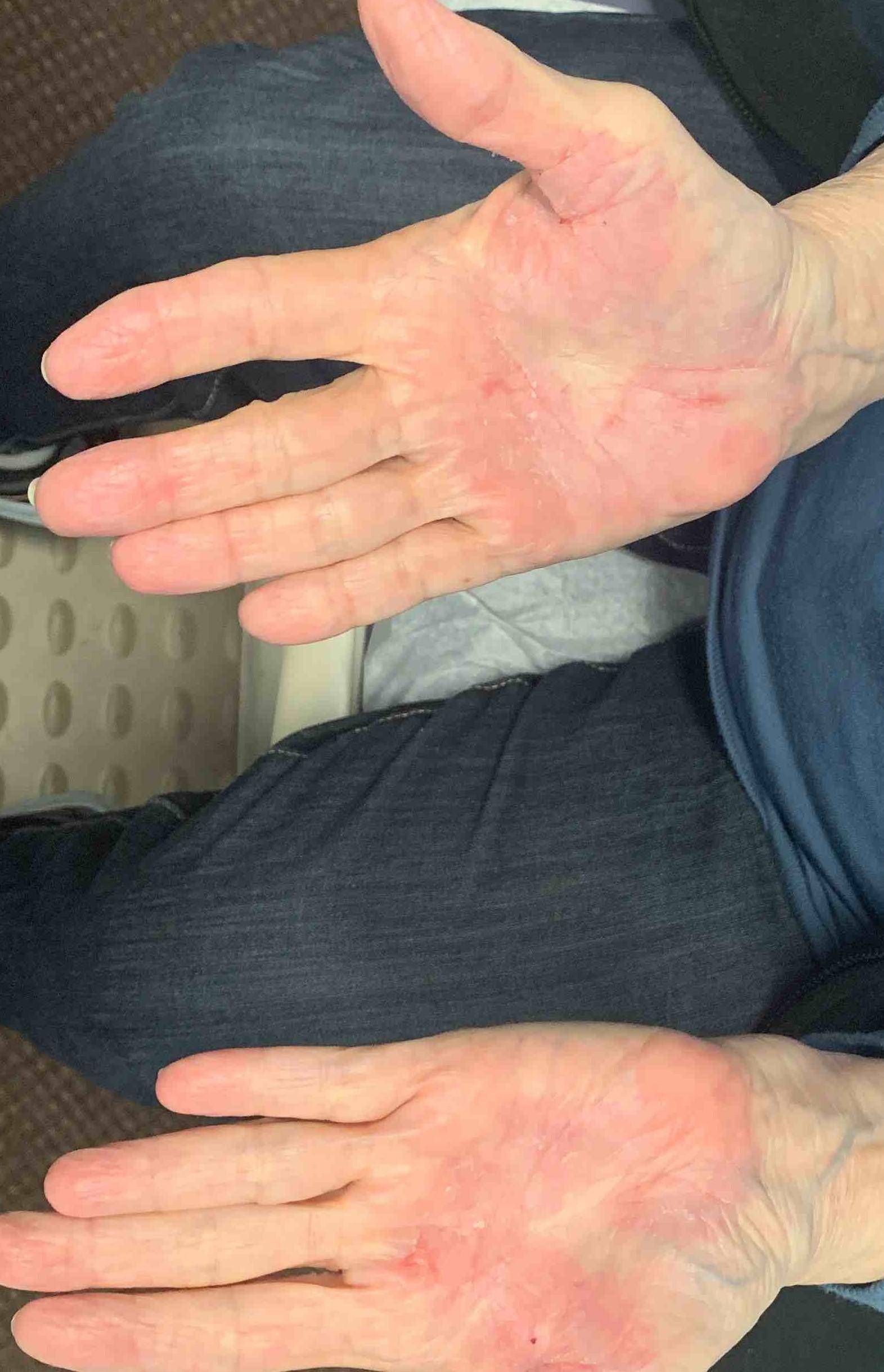 Psoriasis (6 Month Cosentyx) Case-51 Before