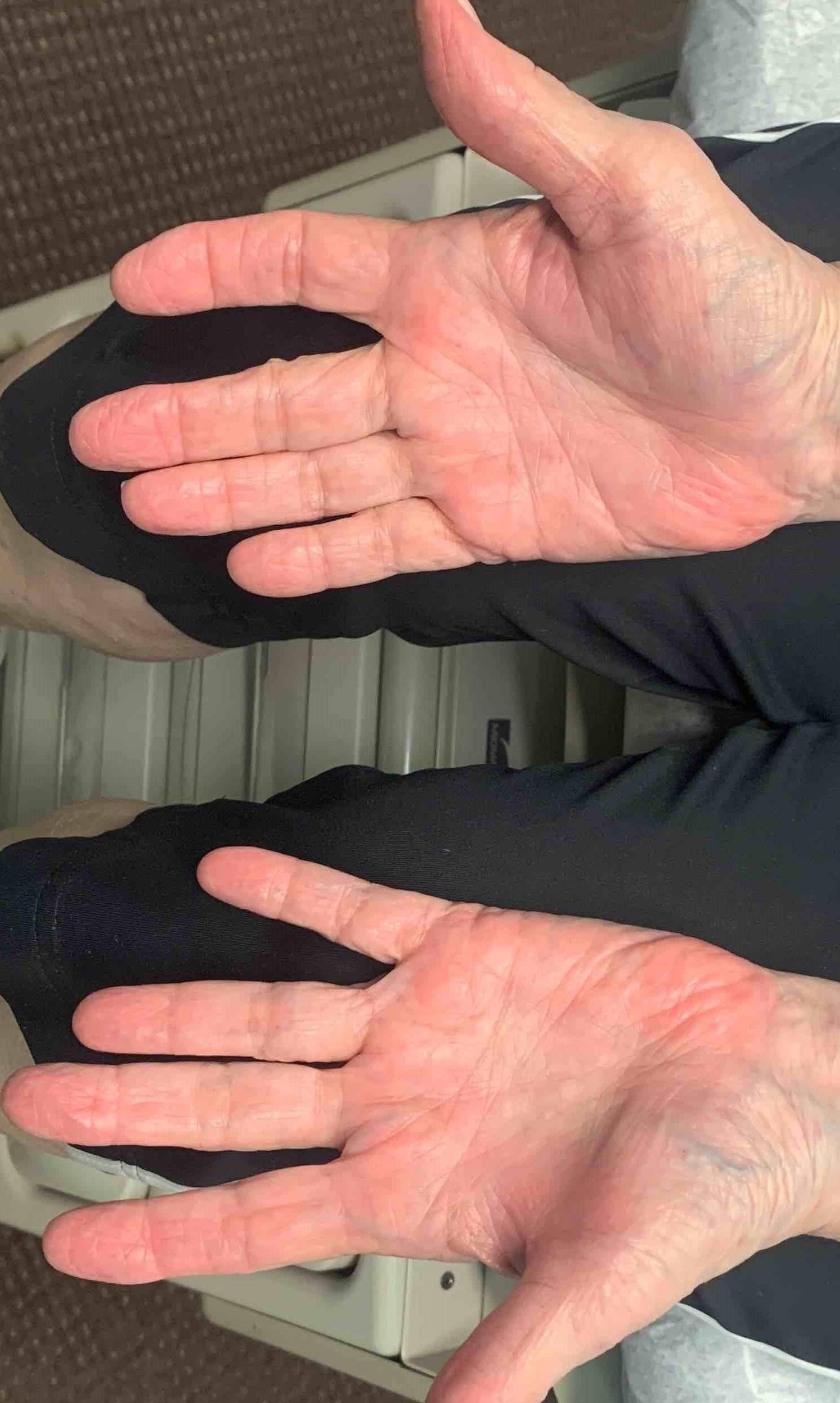 Psoriasis (6 Month Cosentyx) Case-51 After