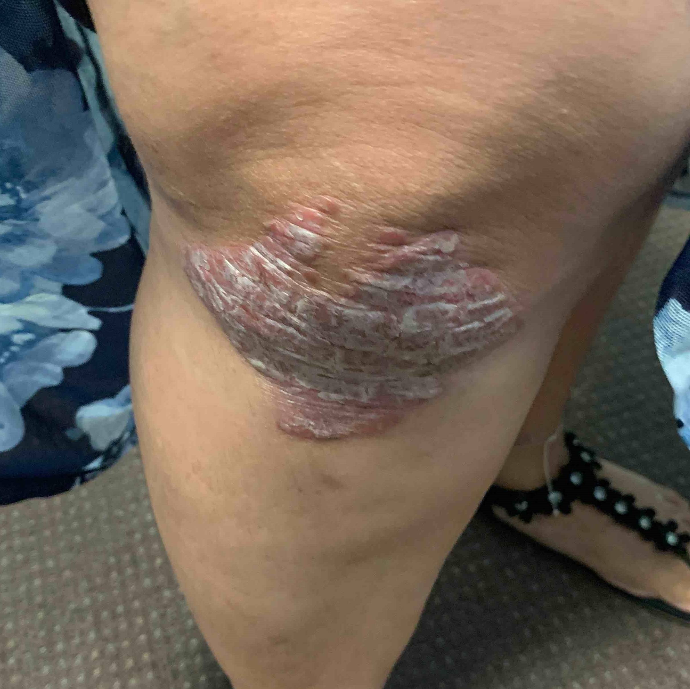 Psoriasis (3 Month Humira) Case-52 Before
