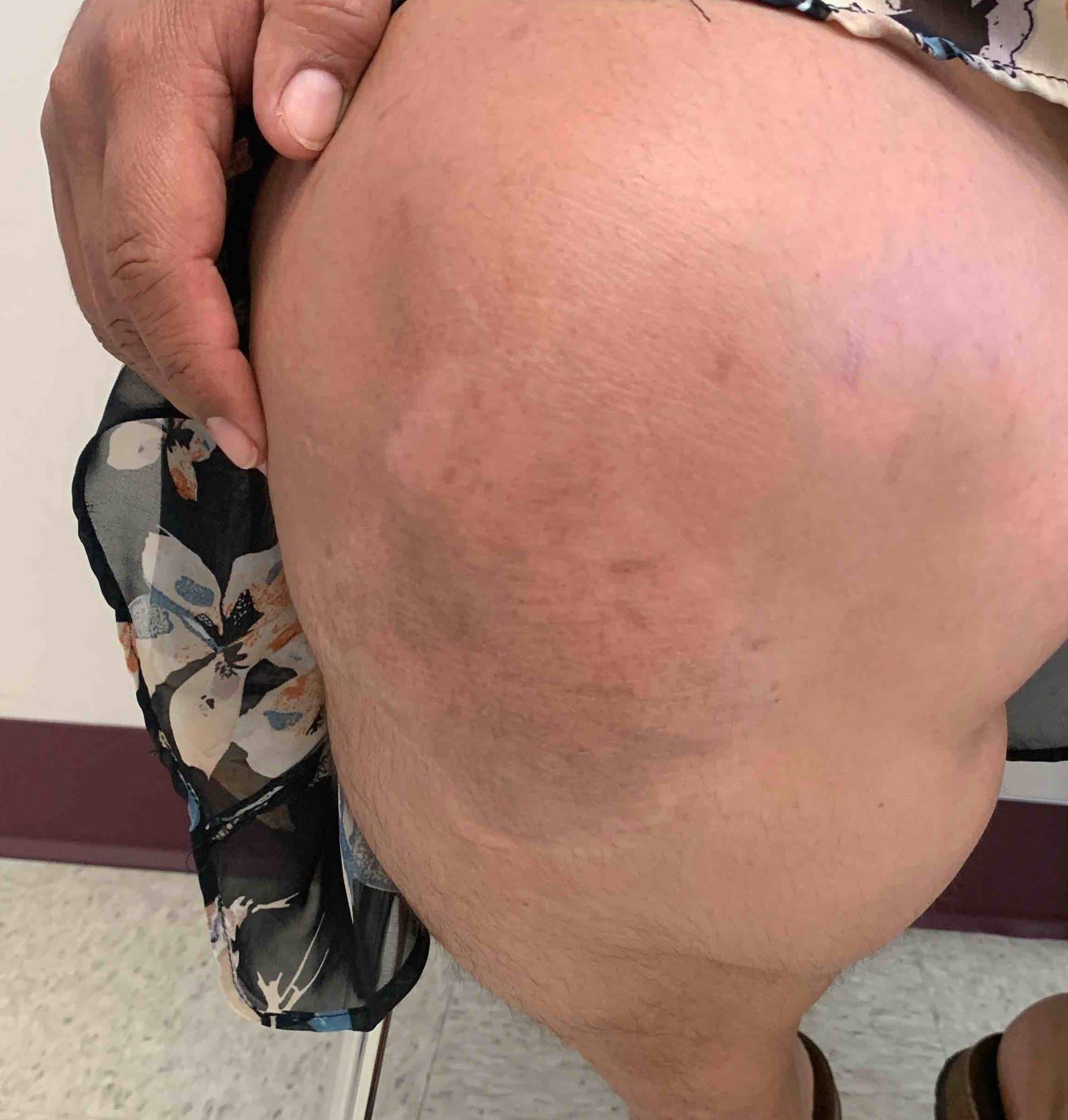 Psoriasis (3 Month Humira) Case-52 After