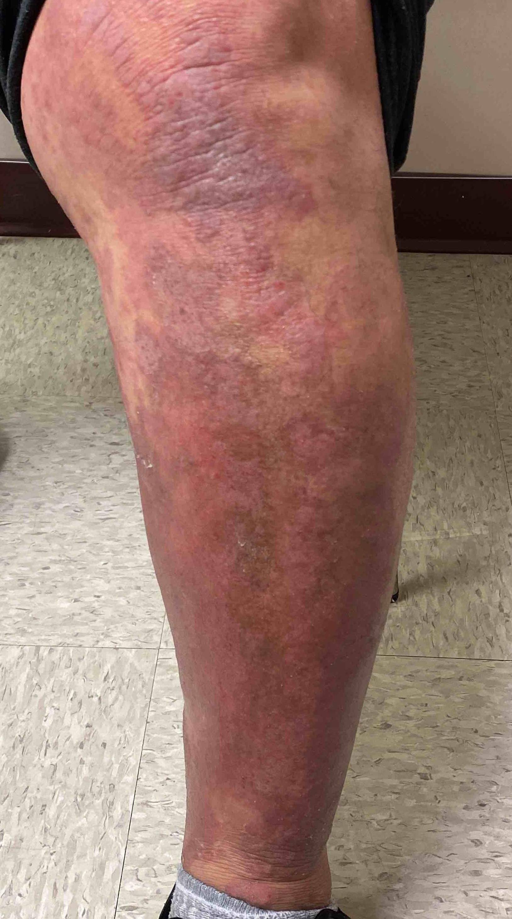 Psoriasis (6 Months Cosentyx) Case-53 Before