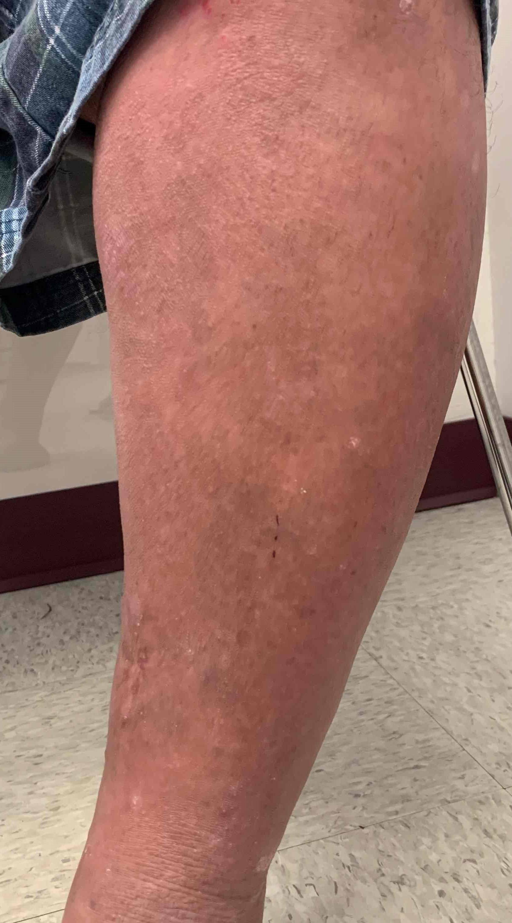 Psoriasis (6 Months Cosentyx) Case-53 After