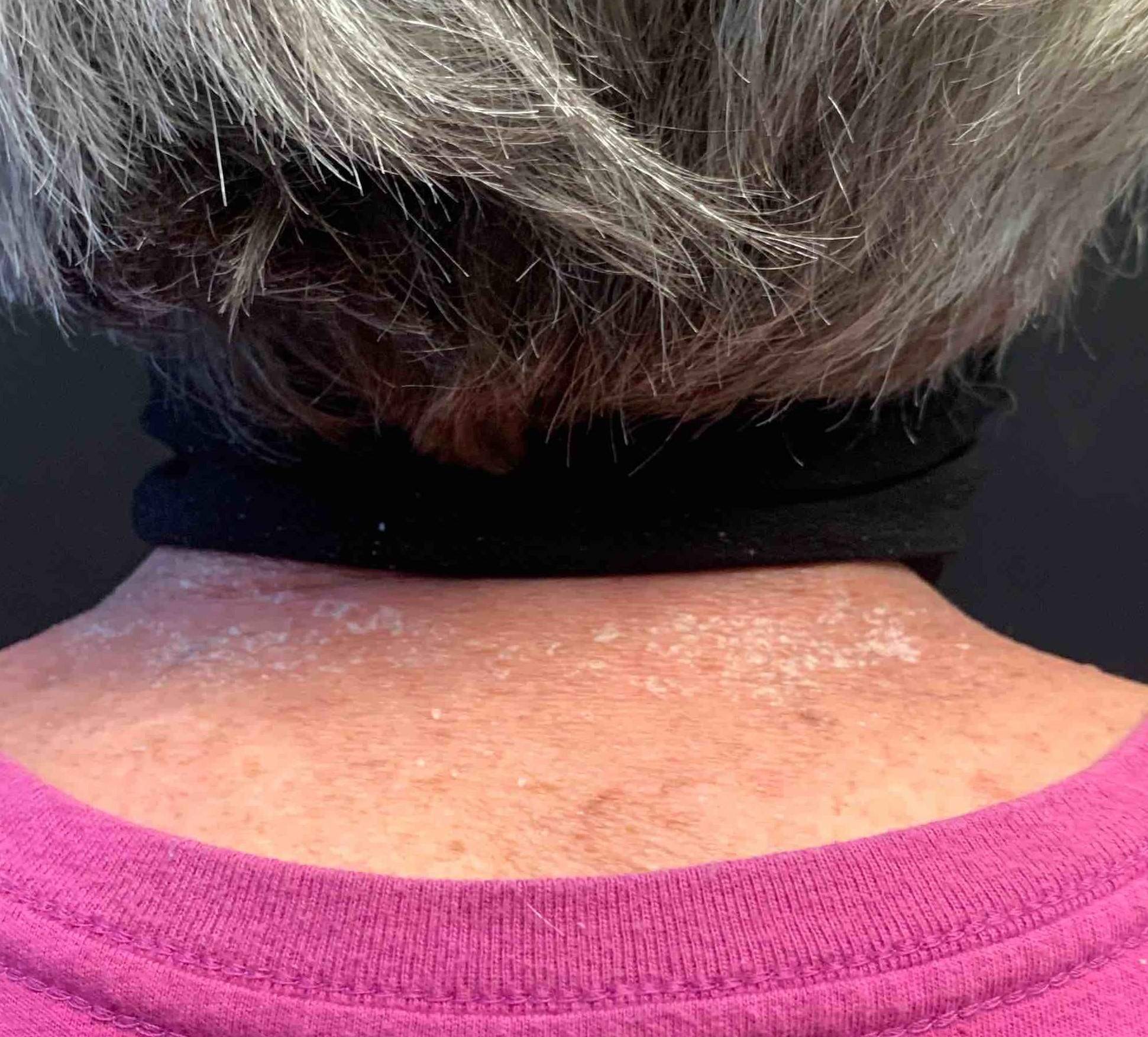 Psoriasis (4 Months Stelara) Case-54 Before