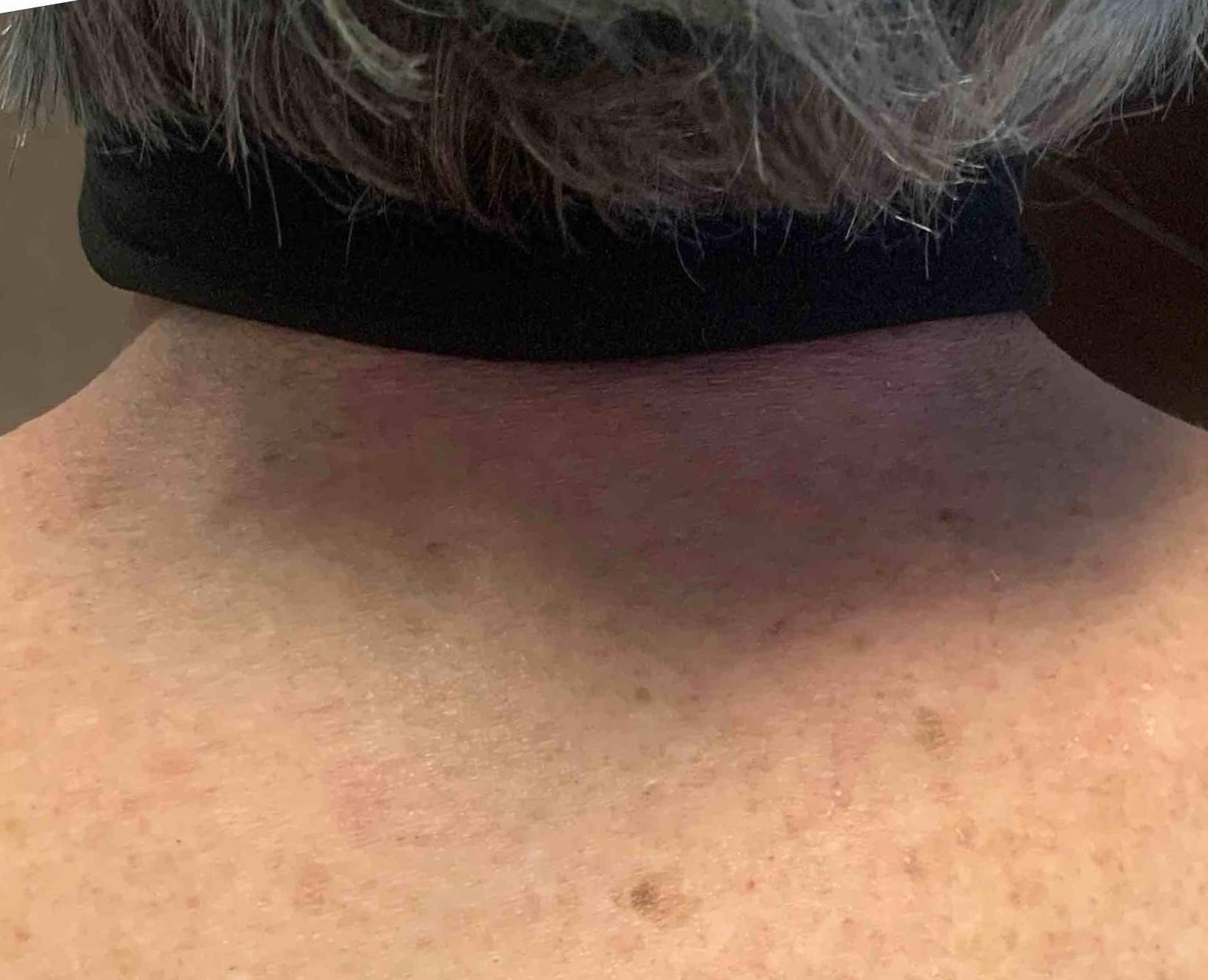 Psoriasis (4 Months Stelara) Case-54 After
