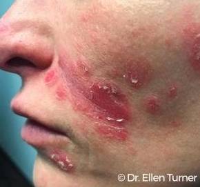 Psoriasis Before and After Case 8 Before