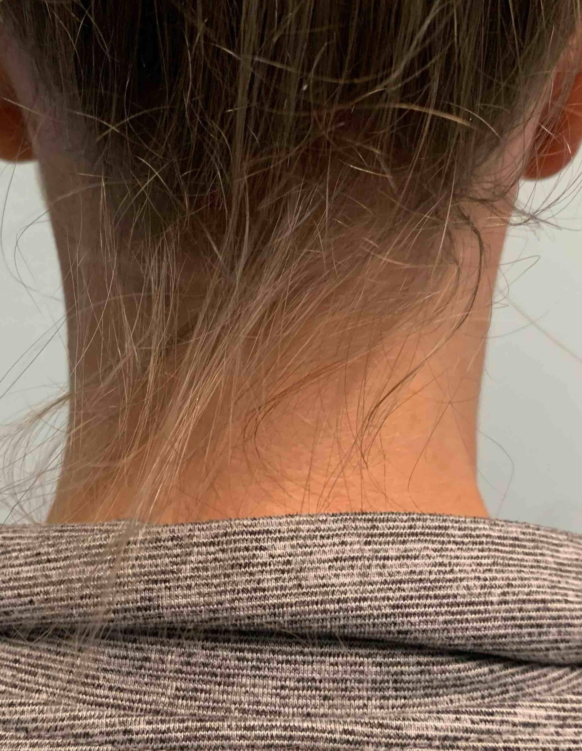 Psoriasis (2 Months Otezla) Case-55 After