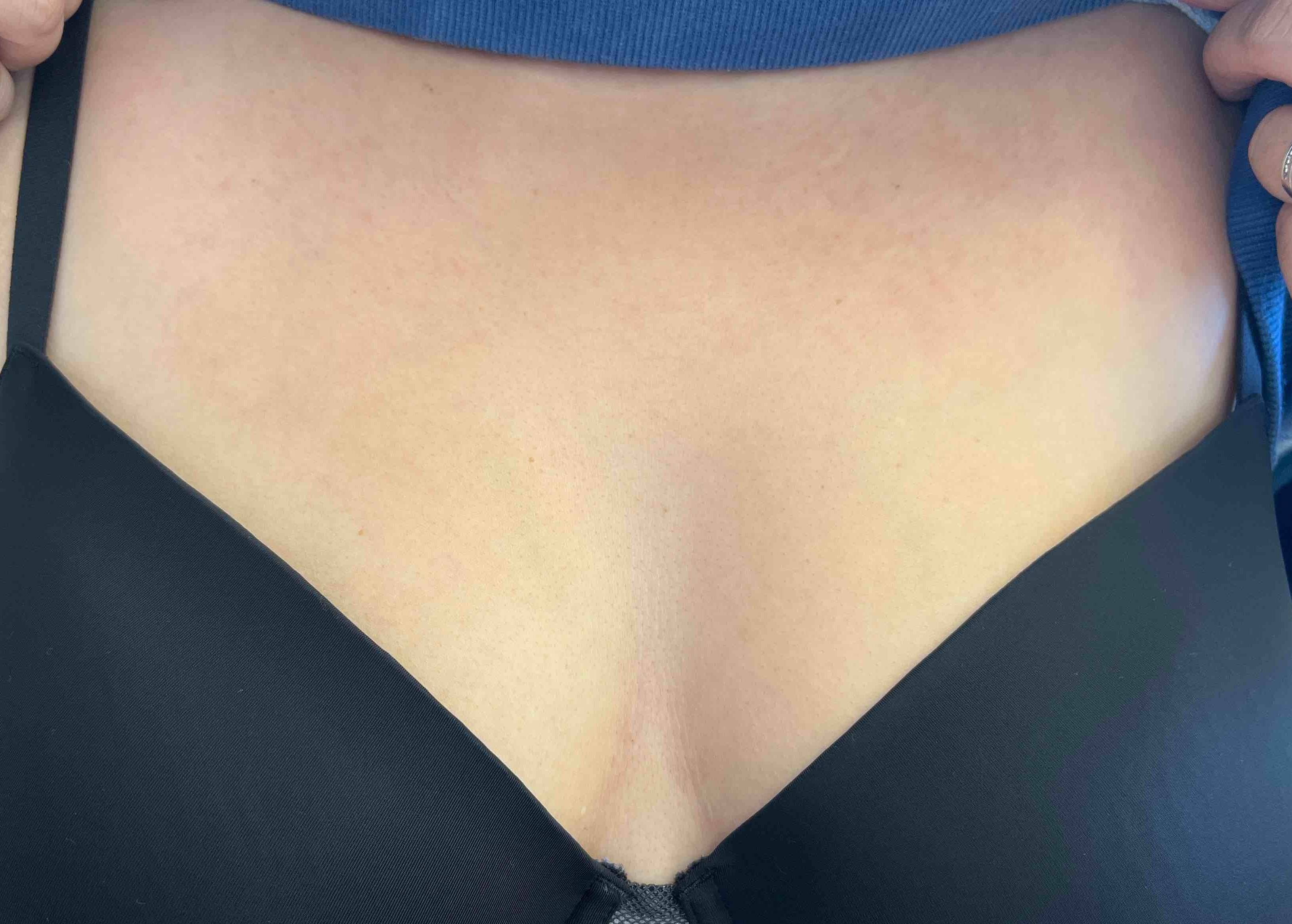 Psoriasis (6 Month Cosentyx) Case-57 After